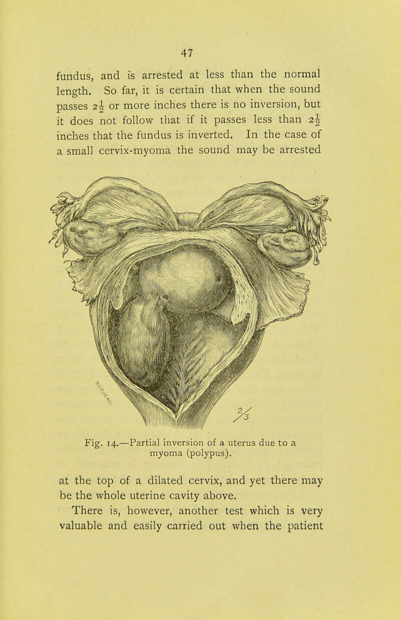 fundus, and is arrested at less than the normal length. So far, it is certain that when the sound passes 2h or more inches there is no inversion, but it does not follow that if it passes less than 2| inches that the fundus is inverted. In the case of a small cervix-myoma the sound may be arrested Fig. 14.—Partial inversion of a uterus due to a myoma (polypus). at the top of a dilated cervix, and yet there may be the whole uterine cavity above. There is, however, another test which is very valuable and easily carried out when the patient