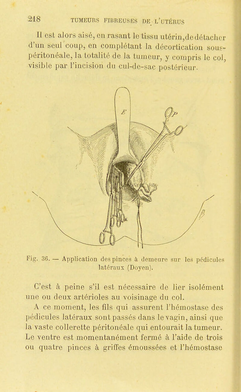 Il est alors aisé, en rasant le tissu utérin,dedétacher d'un seul coup, en complétant la décortication sous- péritonéale, la totalité de la tumeur, y compris le col, visible par l'incision du cul-de-sac postérieur. Fig. 36. — Application des pinces à. demeure snr les pédicules latéraux (Doyen). C'est à peine s'il est nécessaire de lier isolément une ou deux artérioles au voisinage du col. A ce moment, les fds qui assurent l'hémostase des pédicules latéraux sont passés dans le vagin, ainsi que la vaste collerette péritonéale qui entourait la tumeur. Le ventre est momentanément fermé à l'aide de trois ou quatre pinces à griffes émoussées et l'hémostase