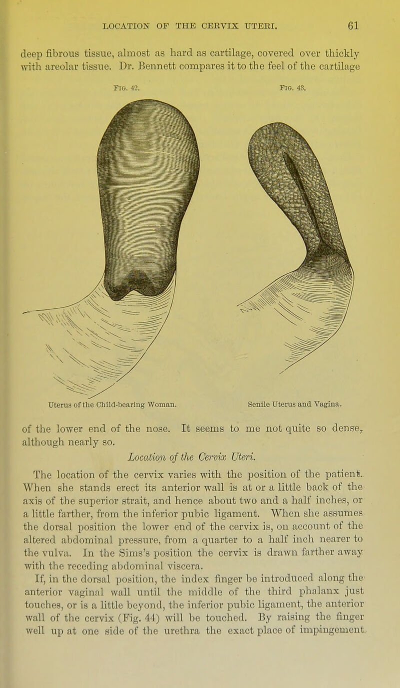 deep fibrous tissue, almost as hard as cartilage, covered over thickly with areolar tissue. Dr. Bennett compares it to the feel of the cartilage Fig. 42. Pig. 43. Uterus of the Child-bearing Woman. Senile Uterus and Vagina. of the lower end of the nose. It seems to me not quite so dense,, although nearly so. Location of the Cervix Uteri. The location of the cervix varies with the position of the patient. When she stands erect its anterior wall is at or a little back of the axis of the superior strait, and hence about two and a half inches, or a little farther, from the inferior pubic ligament. When she assumes the dorsal position the lower end of the cervix is, on account of the altered abdominal pressure, from a quarter to a half inch nearer to the vulva. In the Sims's position the cervix is drawn farther away with the receding abdominal viscera. If, in the dorsal position, the index finger be introduced along the anterior vaginal wall until the middle of the third phalanx just touches, or is a little beyond, the inferior pubic ligament, the .interior wall of the cervix (Fig. 44) will be touched. By raising the finger well up at one side of the urethra the exact place of impingement