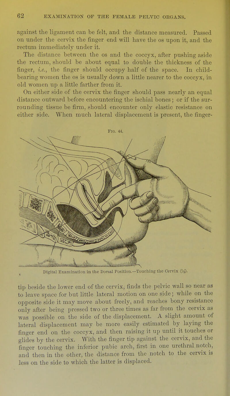 against the ligament can be felt, and the distance measured. Passed on under the cervix the finger end will have the os upon it, and the rectum immediately under it. The distance between the os and the coccyx, after pushing aside the rectum, should be about equal to double the thickness of the finger, i.e., the finger should occupy half of the space. In child- bearing women the os is usually down a little nearer to the coccyx, in old women up a little farther from it. On either side of the cervix the finger should pass nearly an equal distance outward before encountering the ischial bones ; or if the sur- rounding tissue be firm, should encounter only elastic resistance on either side. When much lateral displacement is present, the finger- Fig. 44. Digital Examination in the Dorsal Position.—Touching the Cervix {lyQ. tip beside the lower end of the cervix, finds the pelvic wall so near as to leave space for but little lateral motion on one side; while on the opposite side it may move about freely, and reaches bony resistance only after being pressed two or three times as far from the cervix as was possible on the side of the displacement. A slight amount of lateral displacement may be more easily estimated by laying the finger end on the coccyx, and then raising it up until it touches or glides by the cervix. With the finger tip against the cervix, and the finger touching the inferior pubic arch, first in one urethral notch, and then in the other, the distance from the notch to the cervix is less on the side to which the latter is displaced.