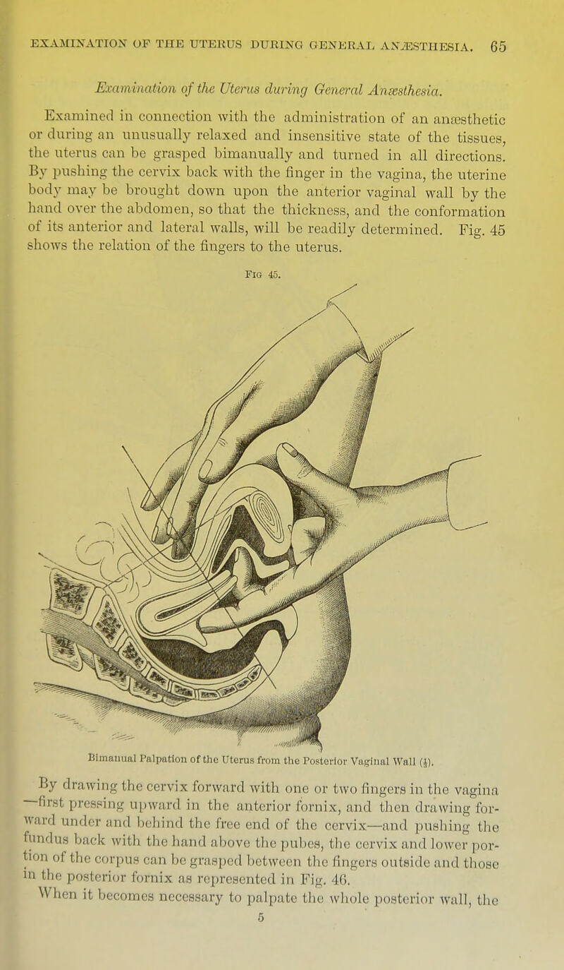 Examination of the Uterus during General Anaesthesia. Examined in connection with the administration of an anaesthetic or during an unusually relaxed and insensitive state of the tissues, the uterus can be grasped bimanually and turned in all directions. By pushing the cervix back with the finger in the vagina, the uterine body may be brought clown upon the anterior vaginal wall by the hand over the abdomen, so that the thickness, and the conformation of its anterior and lateral walls, will be readily determined. Fig. 45 shows the relation of the fingers to the uterus. Fig 45. Bimauual Palpation of the Uterus from the Posterior Vaginal Wall (J). By drawing the cervix forward with one or two fingers in the vagina —first pressing upward in the anterior fornix, and then drawing for- ward under and behind the free end of the cervix—and pushing the nindus hack with the hand above the pubes, the cervix and Lower por- !' 0I the corpus can be grasped between the fingers outside and those in the posterior fornix as represented in Fig. 46. W hen it becomes necessary to palpate the whole posterior wall, the 5