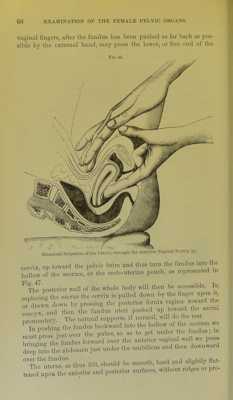 vaginal fingers, after the fundus has been pushed as far back as pos- sible by the external hand, may press the lower, or free end of the Fig. 40. Bimanual Palpation of the Utem,?through the Anterior Vaginal Fornix (J). cervix up toward the pelvic brim and thus turn the fundus into the hollow of the sacrum, or the recto-uterine pouch, as represented m The posterior wall of the whole body will then be accessible. In replacing the uterus the cervix is pulled clown by the finger upon it, or drawn down by pressing the posterior fornix vagina, toward the coccvx and then the fundus uteri pushed up toward the sacral Promontory. The natural supports, if normal, will do the rest. PTpushing the fundus backward into the hollow of the sacrum we mitt p e^st over the pubes, so as to gel under the undus; in WW 4 fondus forward over the anterior vagina wall we press deepgil the abdomen just under the umbilicus and then downward °VThehuttuss thus felt, should be smooth, hard and slightly flat- tened uponTh^ Interior and posterior surfaces, without ridges or pro-