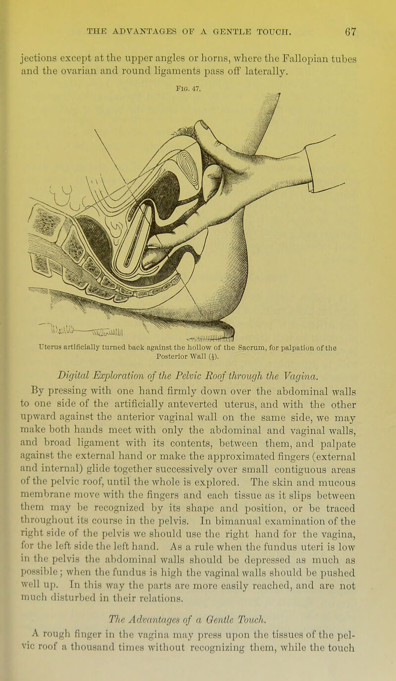 jectii ras except at the upper angles or horns, where the Fallopian tubes and the ovarian and round ligaments pass off laterally. Fig. 47. Uterus artificially turned back against the hollow of the Sacrum, for palpation of the Posterior Wall (J). Digital Exploration of the Pelvic Roof through the Vagina. By pressing with one hand firmly down over the abdominal walls to one side of the artificially anteverted uterus, and with the other upward against the anterior vaginal wall on the same side, we may make both hands meet with only the abdominal and vaginal walls, and broad ligament with its contents, between them, and palpate against the external hand or make the approximated fingers (external and internal) glide together successively over small contiguous areas of the pelvic roof, until the whole is explored. The skin and mucous membrane move with the fingers and each tissue as it slips between them may be recognized by its shape and position, or be traced throughout its course in the pelvis. In bimanual examination of the right side of the pelvis we should use the right hand for the vagina, for the left side the left hand. As a rule when the fundus uteri is low in the pelvis the abdominal walls should be depressed as much as possible ; when the fundus is high the vaginal walls should be pushed well up. In this way the parts are more easily reached, and are not much disturbed in their relations. The Advantages of a Gentle Touch. A rough finger in the vagina may press upon the tissues of (lie pel- vic roof a thousand times without recognizing them, while the touch