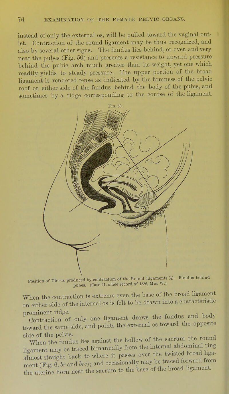 instead of only the external os, will be pulled toward the vaginal out- let. Contraction of the round ligament may be thus recognized, and also by several other signs. The fundus lies behind, or over, and very near the pubes (Fig. 50) and presents a resistance to upward pressure behind the pubic arch much greater than its weight, yet one which readily yields to steady pressure. The upper portion of the broad ligament is rendered tense as indicated by the firmness of the pelvic roof or either side of the fundus behind the body of the pubis, and sometimes by a ridge corresponding to the course of the ligament. Fig. 50. Position of Uterus produced by contraction of the Round Ligaments (fl. Fundus behind pubes. (Case 21, office record of 1886, Mrs. W.) When the contraction is extreme even the base of the broad ligament on either side of the internal os is felt to be drawn into a characteristic PXntoctoSof only one ligament draws the fundus and body toward the same side, and points the external os toward the opposite side of the pelvis. , When the fundus lies against the hollow of the sacrum the round ligament may be traced bimanually from the internal abdormnal rang almost straight back to where it passes over the twisted broad iga- ment (Fig. 6, br and brc); and occasionally may be traced forward from Z uterine horn near the sacrum to the base of the broad ligament.