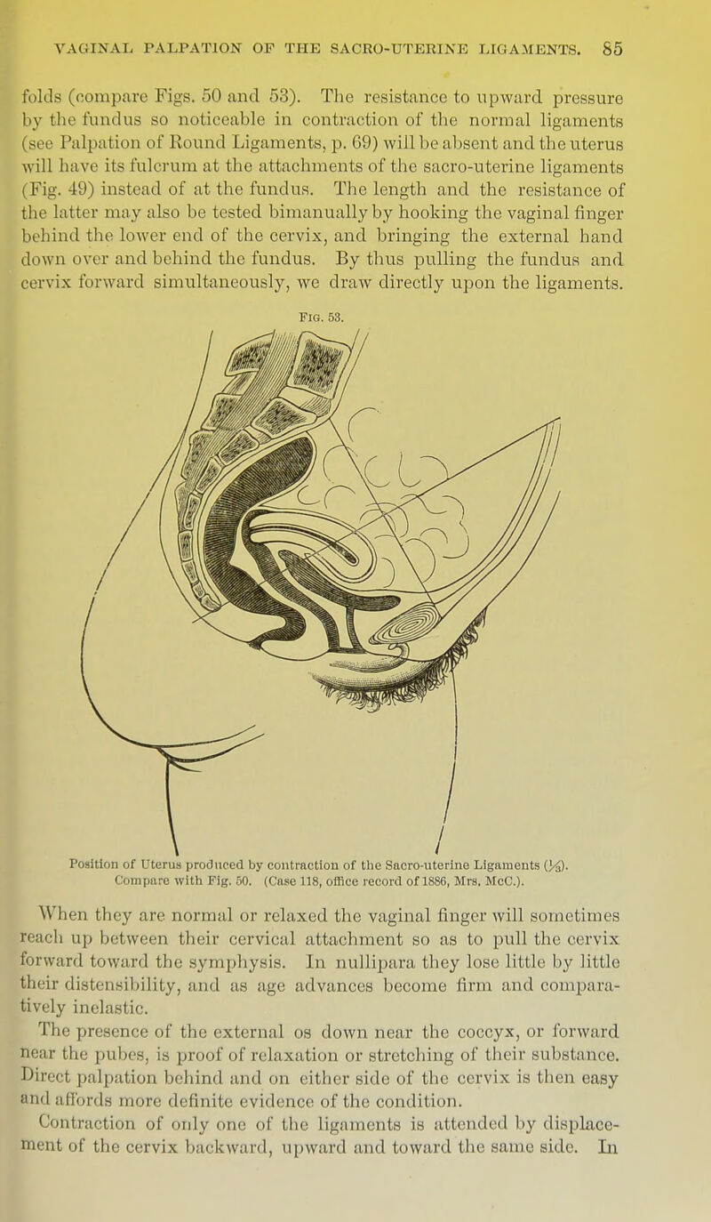 folds (compare Figs. 50 and 53). The resistance to upward pressure by the fundus so noticeable in contraction of the normal ligaments (see Palliation of Round Ligaments, p. 69) will be absent and the uterus will have its fulcrum at the attachments of the sacro-uterine ligaments (Fig. 49) instead of at the fundus. The length and the resistance of the latter may also be tested bimanuallyby hooking the vaginal finger behind the lower end of the cervix, and bringing the external hand down over and behind the fundus. By thus pulling the fundus and cervix forward simultaneously, we draw directly upon the ligaments. Fig. 53. Position of Uterus produced by contraction of the Sacro-uterine Ligaments (J/J). Compare with Fig. 50. (Case 118, office record of 1886, Mrs, McC). When they are normal or relaxed the vaginal finger will sometimes reach up between their cervical attachment so as to pull the cervix forward toward the symphysis. In nullipara they lose little by little their distensibility, and as age advances become firm and compara- tively inelastic. The presence of the external os down near the coccyx, or forward near the pubes, is proof of relaxation or stretching of their substance. Direct palliation behind and on either side of the cervix is then easy and affords more definite evidence of the condition. Contraction of only one of the ligaments is attended by displace- ment of the cervix backward, upward and toward the same side. In
