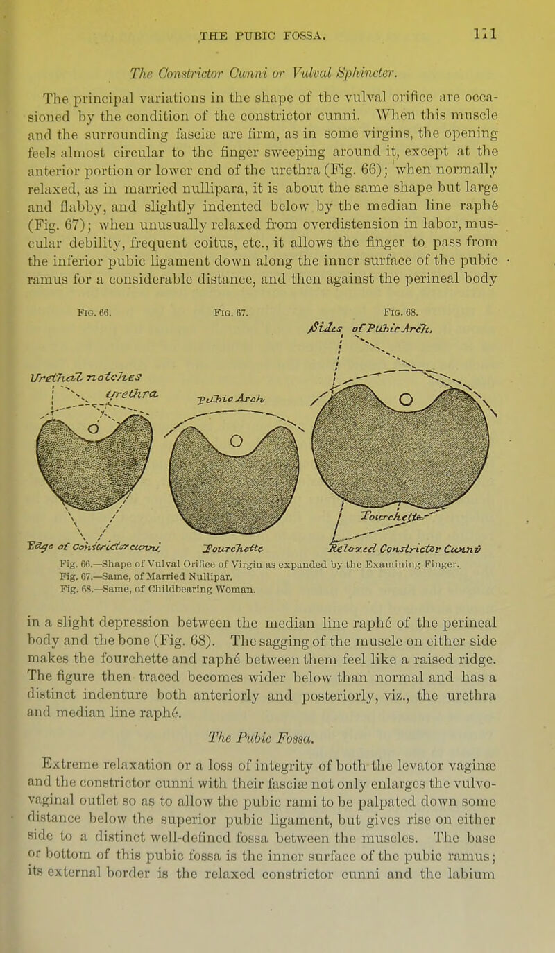 The Constrictor Cunni or Vulval Sphincter. The principal variations in the shape of the vulval orifice are occa- sioned hy the condition of the constrictor cunni. When this muscle and the surrounding fascia; are firm, as in some virgins, the opening feels almost circular to the finger sweeping around it, except at the anterior portion or lower end of the urethra (Fig. 66); when normally relaxed, as in married nullipara, it is about the same shape but large and flabby, and slightly indented below by the median line raphe (Fig. 67); when unusually relaxed from overdistension in labor, mus- cular debility, frequent coitus, etc., it allows the finger to pass from the inferior pubic ligament down along the inner surface of the pubic ramus for a considerable distance, and then against the perineal body Fig. 66. Fig. 67. Fig. 68. jSuUs o€J>tXbieArih, TIclyc of Constrictor cunnJ. Towrchettc Tteloy.td Constrictor Ccomv Fig. 66.—Shape of Vulval Orifice of Virgin as expanded by the Examining Finger. Fig. 67.—Same, of Married Nullipar. Fig. 68.—Same, of Childbearing Woman. in a slight depression between the median line raphe of the perineal body and the bone (Fig. 68). The sagging of the muscle on either side makes the fourchette and raphe between them feel like a raised ridge. The figure then traced becomes wider below than normal and has a distinct indenture both anteriorly and posteriorly, viz., the urethra and median line raph6. The Pubic Fossa. Extreme relaxation or a loss of integrity of both the levator vagina- anil the constrictor cunni with their fascise not only enlarges the vulvo- vaginal outlet so as to allow the pubic rami to be palpated down some distance below the superior pubic ligament, but gives rise on either side to a distinct well-defined fossa between the muscles. The base (»r boll..m (if this pubic fossa, is the inner surface of the pubic ramus; its external border is the relaxed constrictor cunni and the labium