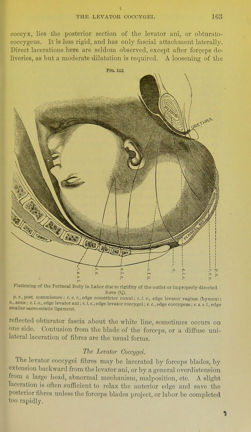 THE LEVATOR COCCYGET. 1G3 coccyx, lies the posterior section of the levator ani, or obturato- eoccygeus. It is less rigid, and lias only fascial attachment laterally. Direct lacerations here are seldom observed, except after forceps de- liveries, as but a moderate dilatation is required. A loosening of the fig. 112. Flattening of the Perineal Body in Labor due to rigidity of the outlet or improperly directed force (%). p. &, post, commissure ; e. c. c, edge constrictor cunni; e. I. v., edge levator vaginte (hymen); a., anus ; e. I. a., edge levator ani; e.I. c,edge levator coccygei; e. c, edge coccygeus; e. s. s./..edge smaller sacro-sciatic ligament. reflected obturator fascia about the white line, sometimes occurs on one side. Contusion from the blade of the forceps, or a diffuse uni- lateral laceration of fibres are the usual forms. TJie Levator Coccygei. The levator coccygei fibres may be lacerated by forceps blades, by extension backward from the levator ani, or by a general overdistension from a large head, abnormal mechanism, malposition, etc. A slight laceration is often sufficient to relax the anterior edge and save the posterior fibres unless the forceps blades project, or labor be oompleted too rapidly.