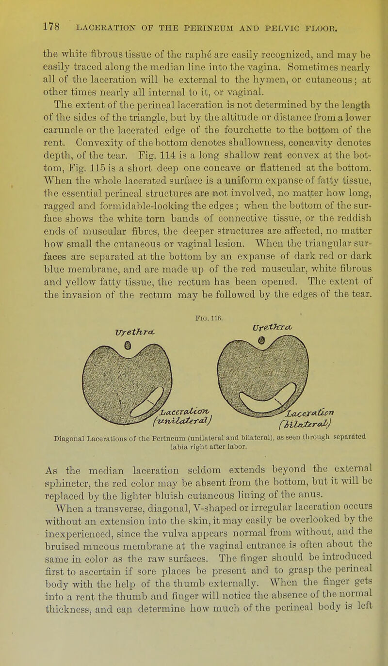 the white fibrous tissue of the raph6 are easily recognized, and may be easily traced along the median line into the vagina. Sometimes nearly all of the laceration will be external to the hymen, or cutaneous; at other times nearly all internal to it, or vaginal. The extent of the perineal laceration is not determined by the length of the sides of the triangle, but by the altitude or distance from a lower caruncle or the lacerated edge of the fourchette to the bottom of the rent. Convexity of the bottom denotes shallowness, concavity denotes depth, of the tear. Fig. 114 is a long shallow rent convex at the bot- tom, Fig. 115 is a short deep one concave or flattened at the bottom. When the whole lacerated surface is a uniform expanse of fatty tissue, the essential perineal structures are not involved, no matter how long, ragged and formidable-looking the edges ; when the bottom of the sur- face shows the white torn bands of connective tissue, or the reddish ends of muscular fibres, the deeper structures are affected, no matter how small the cutaneous or vaginal lesion. When the triangular sur- faces are separated at the bottom by an expanse of dark red or dark blue membrane, and are made up of the red muscular, white fibrous and yellow fatty tissue, the rectum has been opened. The extent of the invasion of the rectum may be followed by the edges of the tear. Fig. 116. Diagonal Lacerations of the Perineum (unilateral and bilateral), as seen through separated labia right after labor. As the median laceration seldom extends beyond the external sphincter, the red color may be absent from the bottom, but it will be replaced by the lighter bluish cutaneous lining of the anus. When a transverse, diagonal, V-shaped or irregular laceration occurs without an extension into the skin, it may easily be overlooked by the inexperienced, since the vulva appears normal from without, and the bruised mucous membrane at the vaginal entrance is often about the same in color as the raw surfaces. The finger should be introduced first to ascertain if sore places be present and to grasp the perineal body with the help of the thumb externally. When the finger gets into a rent the thumb and finger will notice the absence of the normal thickness, and can determine how much of the perineal body is left