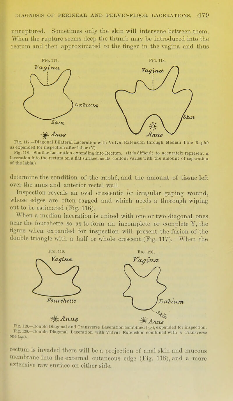 unruptured. Sometimes only the skin will intervene between them. When the rupture seems deep the thumb may be introduced into the rectum and then approximated to the finger in the vagina and thus Fig. 117. Fig. 118. Fig. 117.—Diagonal Bilateral Laceration with Vulval Extension through Median Line RaphS as expanded for inspection after labor (Y). Fig. 118 —Similar Laceration extending into Rectum. (It is difficult to accurately represent a laceration into the rectum on a flat surface, as its contour varies with the amount of separation of the labia.) determine the condition of the raphe, and the amount of tissue left over the anus and anterior rectal wall. Inspection reveals an oval crescentic or irregular gaping wound, whose edges are often ragged and which needs a thorough wiping out to be estimated (Fig. 116). Wh en a median laceration is united with one or two diagonal ones near the fourchette so as to form an incomplete or complete Y, the figure when expanded for inspection will present the fusion of the double triangle with a half or whole crescent (Fig. 117). When the Fig. 119. Fig. 120. Vagina, Vagina Fourchette j Jjuabivurrv *<t* Fig. 119.—Double Diagonal and Transverse Laceration combined (^), expanded for inspection. Pig. 120.—Double Diagonal Laceration with Vulval Extension combined with a Transverse one (-y.). rectum is invaded there will be a projection of anal skin and mucous membrane into the external cutaneous edge (Fig. 118), and a more extensive raw surface on either side.