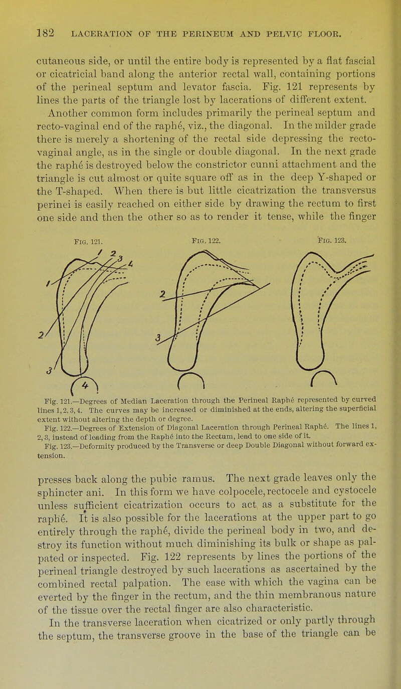 cutaneous side, or until the entire body is represented by a flat fascial or cicatricial band along the anterior rectal wall, containing portions of the perineal septum and levator fascia. Fig. 121 represents by lines the parts of the triangle lost by lacerations of different extent. Another common form includes primarily the perineal septum and recto-vaginal end of the raphe, viz., the diagonal. In the milder grade there is merely a shortening of the rectal side depressing the recto- vaginal angle, as in the single or double diagonal. In the next grade the raph6 is destroyed below the constrictor cunni attachment and the triangle is cut almost or quite square off as in the deep Y-shaped or the T-shaped. When there is but little cicatrization the transversus perinei is easily reached on either side by drawing the rectum to first one side and then the other so as to render it tense, while the finger Fig. 121. Fig. 122. Fig. 123. Fig. 121.—Degrees of Median Laceration through the Perineal Raphe represented by curved lines 1,2, 3,4. The curves may be increased or diminished at the ends, altering the superficial extent without altering the depth or degree. Fig. 122—Degrees of Extension of Diagonal Laceration through Perineal Raphe. The lines 1, 2,3, instead of leading from the Raphe into the Rectum, lead to one side of it Fig. 123.—Deformity produced by the Transverse or deep Double Diagonal without forward ex- tension. presses back along the pubic ramus. The next grade leaves only the sphincter ani. In this form we have colpocele,rectocele and cystocele unless sufficient cicatrization occurs to act, as a substitute for the raphe. It is also possible for the lacerations at the upper part to go entirely through the raph6, divide the perineal body in two, and de- stroy its function without much diminishing its bulk or shape as pal- pated or inspected. Fig. 122 represents by lines the portions of the perineal triangle destroyed by such lacerations as ascertained by the combined rectal palpation. The ease with which the vagina can be everted by the finger in the rectum, and the thin membranous nature of the tissue over the rectal finger are also characteristic. In the transverse laceration when cicatrized or only partly through the septum, the transverse groove in the base of the triangle can be