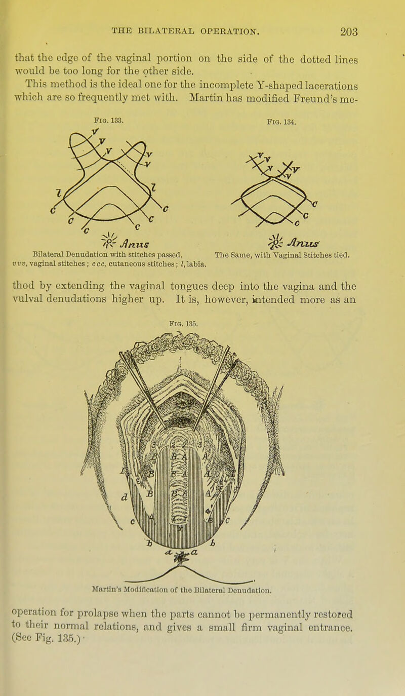 that the edge of the vaginal portion on the side of the dotted lines would be too long for the other side. This method is the ideal one for the incomplete Y-shaped lacerations which are so frequently met with. Martin has modified Freund's me- ns- 133. Fig. 134. Bilateral Denudation with stitches passed. The Same, with Vaginal Stitches tied. vvv, vaginal stitches ; ccc, cutaneous stitches; I,labia. thod by extending the vaginal tongues deep into the vagina and the vulval denudations higher up. It is, however, intended more as an Pig. 135. Martin's Modification of the Bilateral Denudation. operation for prolapse when the parts cannot be permanently restored to their normal relations, and gives a small firm vaginal entrance. (See Fig. 135.)■