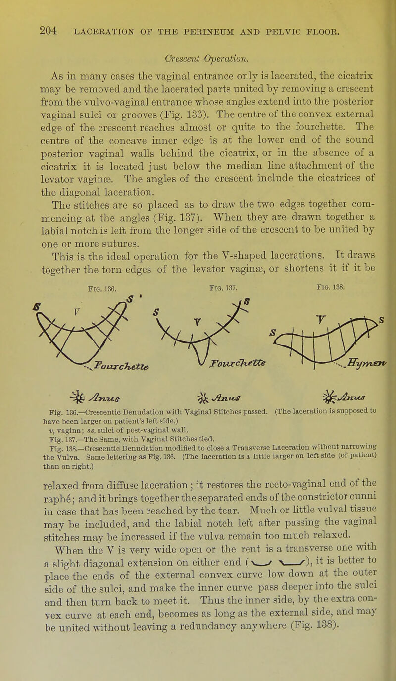 Crescent Operation. As in many cases the vaginal entrance only is lacerated, the cicatrix may be removed and the lacerated parts united by removing a crescent from the vulvo-vaginal entrance whose angles extend into the posterior vaginal sulci or grooves (Fig. 136). The centre of the convex external edge of the crescent reaches almost or quite to the fourchette. The centre of the concave inner edge is at the lower end of the sound posterior vaginal walls behind the cicatrix, or in the absence of a cicatrix it is located just below the median line attachment of the levator vaginae. The angles of the crescent include the cicatrices of the diagonal laceration. The stitches are so placed as to draw the two edges together com- mencing at the angles (Fig. 137). When they are drawn together a labial notch is left from the longer side of the crescent to be united by one or more sutures. This is the ideal operation for the V-shaped lacerations. It draws together the torn edges of the levator vagina?, or shortens it if it be Fig. 136. Fig. 137. Fig. 138. Tig. 136.—Crescentic Denudation with Vaginal Stitches passed. (The laceration is supposed to have been larger on patient's left side.) v, vagina; ss, sulci of post-vaginal wall. Fig. 137—The Same, with Vaginal Stitches tied. Fig. 138—Crescentic Denudation modified to close a Transverse Laceration without narrowing the Vulva. Same lettering as Fig. 136. (The laceration is a little larger on left side (of patient) than on right.) relaxed from diffuse laceration; it restores the recto-vaginal end of the raphe; and it brings together the separated ends of the constrictor cunni in case that has been reached by the tear. Much or little vulval tissue may be included, and the labial notch left after passing the vaginal stitches may be increased if the vulva remain too much relaxed. When the V is very wide open or the rent is a transverse one with a slight diagonal extension on either end (v—r v—it is better to place the ends of the external convex curve low down at the outer side of the sulci, and make the inner curve pass deeper into the sulci and then turn back to meet it. Thus the inner side, by the extra con- vex curve at each end, becomes as long as the external side, and may be united without leaving a redundancy anywhere (Fig. 138).