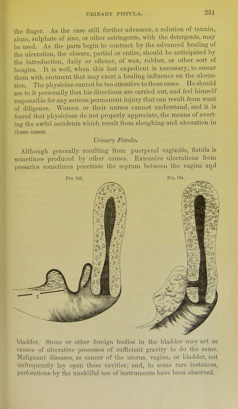 25 L the finger. As the case still further advances, a solution of tannin, . alum, sulphate of zinc, or other astringents, with the detergents, may be used. As the parts begin to contract by the advanced healing of the ulceration, the closure, partial or entire, should be anticipated by the introduction, daily or oftener, of wax, rubber, or other sort of bougies. It is well, when this last expedient is necessary, to smear them with ointment that may exert a healing influence on the ulcera- tion. The physician cannot be too attentive to these cases. He should see to it personally that his directions are carried out, and feel himself responsible for any serious permanent injury that can result from want of diligence. Women or their nurses cannot understand, and it is ti n red that physicians do not properly appreciate, the means of avert- ing the awful accidents which result from sloughing and ulceration in these cases. Urinary FiMula, Although generally resulting from puerperal vaginitis, fistula is sometimes produced by other causes. Extensive ulcerations from pessaries sometimes penetrate the septum between the vagina and Fig. 163. Fig. 164. bladder. Stone or other foreign bodies in the bladder may act as causes of ulcerative processes of sufficient gravity to do the same. Malignant diseases, as cancer of the uterus, vagina, or bladder, not 'infrequently lay open these cavities; and, in some rare instances, perforations by the unskilful use of instruments have been observed.