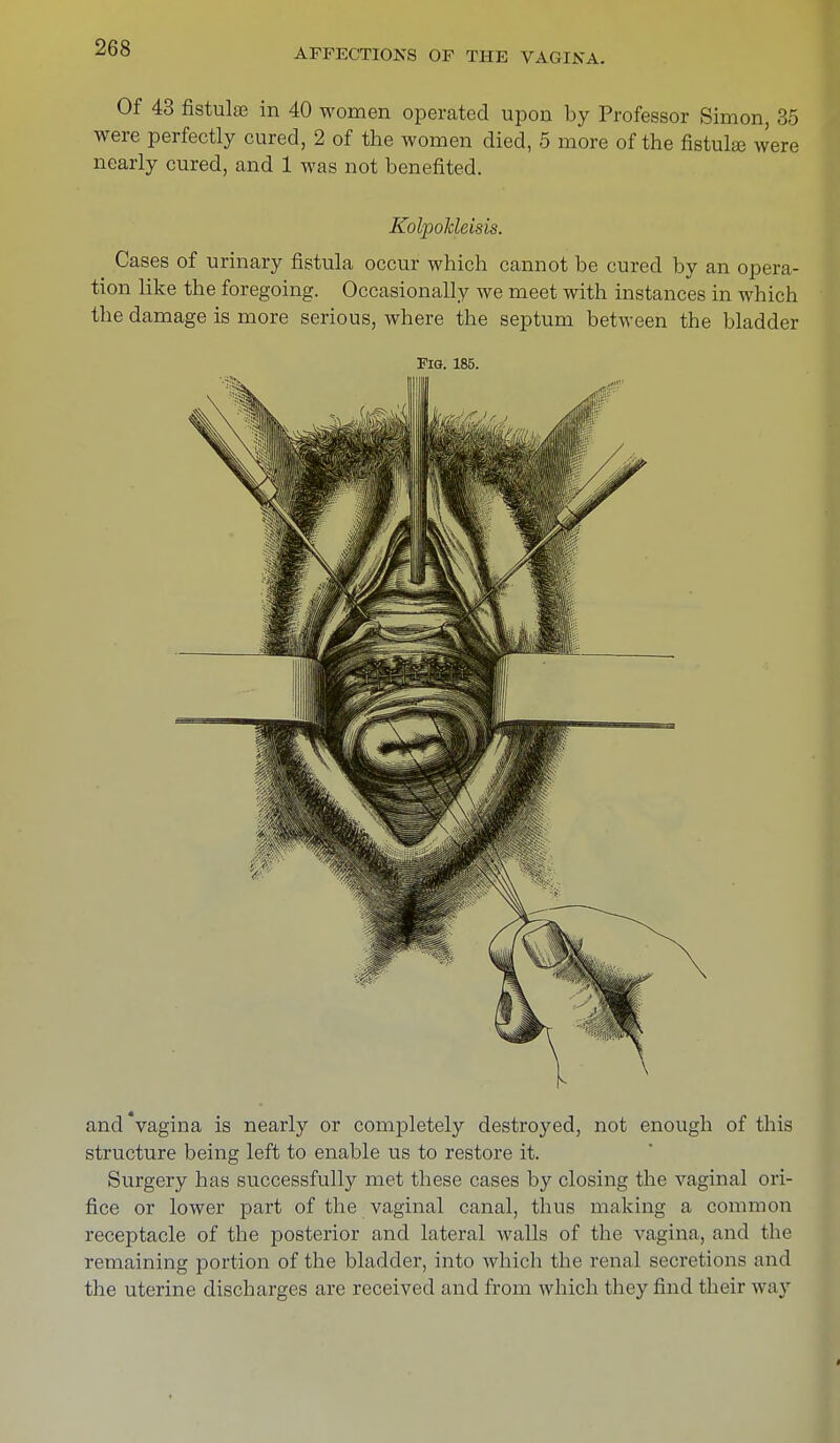 Of 43 fistulse in 40 women operated upon by Professor Simon, 35 were perfectly cured, 2 of the women died, 5 more of the fistulse were nearly cured, and 1 was not benefited. Kolpokleisis. Cases of urinary fistula occur which cannot be cured by an opera- tion like the foregoing. Occasionally we meet with instances in which the damage is more serious, where the septum between the bladder Fig. 185. and Vagina is nearly or completely destroyed, not enough of this structure being left to enable us to restore it. Surgery has successfully met these cases by closing the vaginal ori- fice or lower part of the vaginal canal, thus making a common receptacle of the posterior and lateral walls of the vagina, and the remaining portion of the bladder, into which the renal secretions and the uterine discharges are received and from which they find their way