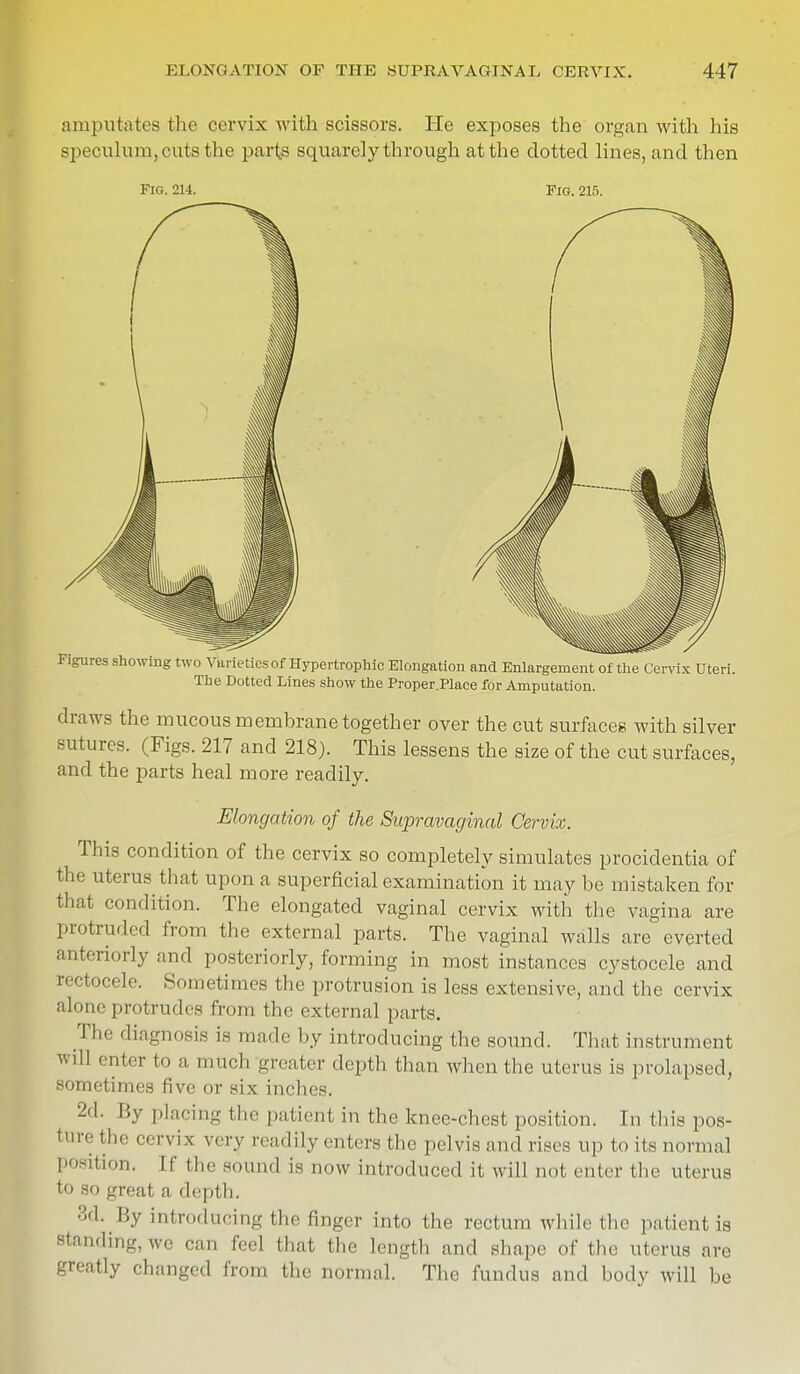 amputates the cervix with scissors. He exposes the organ with his speculum, cuts the parts squarely through at the dotted lines, and then Fig. 214. Fig. 215. Figures showing two Varieties of Hypertrophic Elongation and Enlargement of the Cervix Uteri. The Dotted Lines show the Proper.Place for Amputation. draws the mucous membrane together over the cut surfaces with silver sutures. (Figs. 217 and 218). This lessens the size of the cut surfaces, and the parts heal more readily. Elongation of the Supravaginal Cervix. This condition of the cervix so completely simulates procidentia of the uterus that upon a superficial examination it may be mistaken for that condition. The elongated vaginal cervix with the vagina are protruded from the external parts. The vaginal walls are everted anteriorly and posteriorly, forming in most instances cystocele and rectocele. Sometimes the protrusion is less extensive, and the cervix alone protrudes from the external parts. The diagnosis is made by introducing the sound. That instrument will enter to a, much greater depth than when the uterus is prolapsed, sometimes five or six inches. By Pacing the patient in the knee-chest position. In this pos- ture the cervix very readily enters the pelvis and rises up to its normal P°sition. [f the sound is now introduced it will not enter the uterus to so great a depth. 3d. By introducing the ringer into the rectum while the patient is standing, we can feel that the length and shape of the uterus are greatly changed from the normal. The fundus and body will be