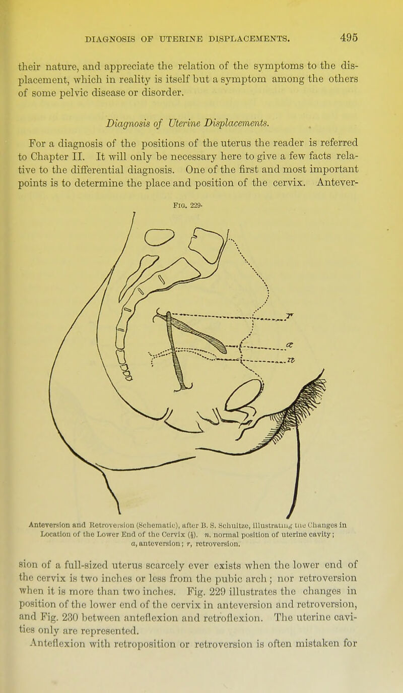 their nature, and appreciate the relation of the symptoms to the dis- placement, which in reality is itself but a symptom among the others of some pelvic disease or disorder. Diagnosis of Uterine Displacements. For a diagnosis of the positions of the uterus the reader is referred to Chapter II. It will only be necessary here to give a few facts rela- tive to the differential diagnosis. One of the first and most important points is to determine the place and position of the cervix. Antever- FIG. 229- Anteversion and Retroversion (Schematic), lifter B. S. Schultzc, illustrating ino Changes in Location of the Lower End of the Cervix (J), n, normal position of uterine cavity; a, anteversion; r, retroversion. sion of a full-sized uterus scarcely ever exists when the lower end of the cervix is two inches or less from the pubic arch ; nor retroversion when it is more than two inches. Fig. 229 illustrates the changes in position of the lower end of the cervix in anteversion and retroversion, and Fig. 230 between anteflexion and retroflexion. The uterine cavi- ties only are represented. Anteflexion with retroposition or retroversion is often mistaken for