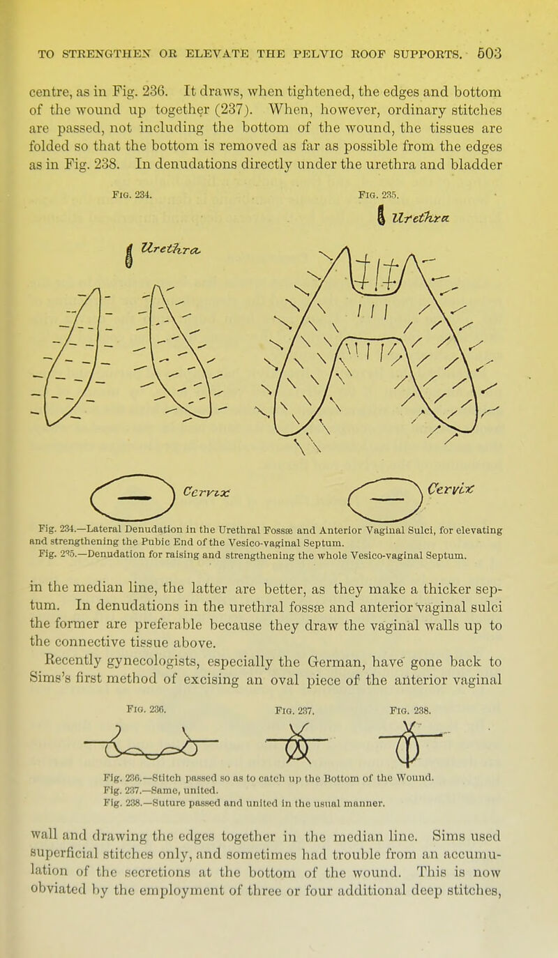 centre, as in Fig. 236. It draws, when tightened, the edges and bottom of the wound up together (237). When, however, ordinary stitches are passed, not including the bottom of the wound, the tissues are folded so that the bottom is removed as far as possible from the edges as in Fig. 238. In denudations directly under the urethra and bladder Fig. 234. Fig. 235. § Urethra Fig. 234.—Lateral Denudation in the Urethral Fossse and Anterior Vaginal Sulci, for elevating and strengthening the Pubic End of the Vesicovaginal Septum. Fig. 2%.—Denudation for raising and strengthening the whole Vesico-vaginal Septum. in the median line, the latter are better, as they make a thicker sep- tum. In denudations in the urethral fossa? and anterior'vaginal sulci the former are preferable because they draw the vaginal walls up to the connective tissue above. Recently gynecologists, especially the German, have gone back to Sims's first method of excising an oval piece of the anterior vaginal Fig. 236. Fig. 287. Fig. 238. Fig. 236.—Stitch passed so as to catch up the Bottom of the Wound. Fig. 237.—Same, united. Fig. 238.—Suture passed and united in the usual manner. wall and drawing the edges together in the median line. Sims used superficial stitches only, and sometimes had trouble from an accumu- lation of the secretions at the bottom of the wound. This is now obviated by the employment of three or four additional deep stitches,