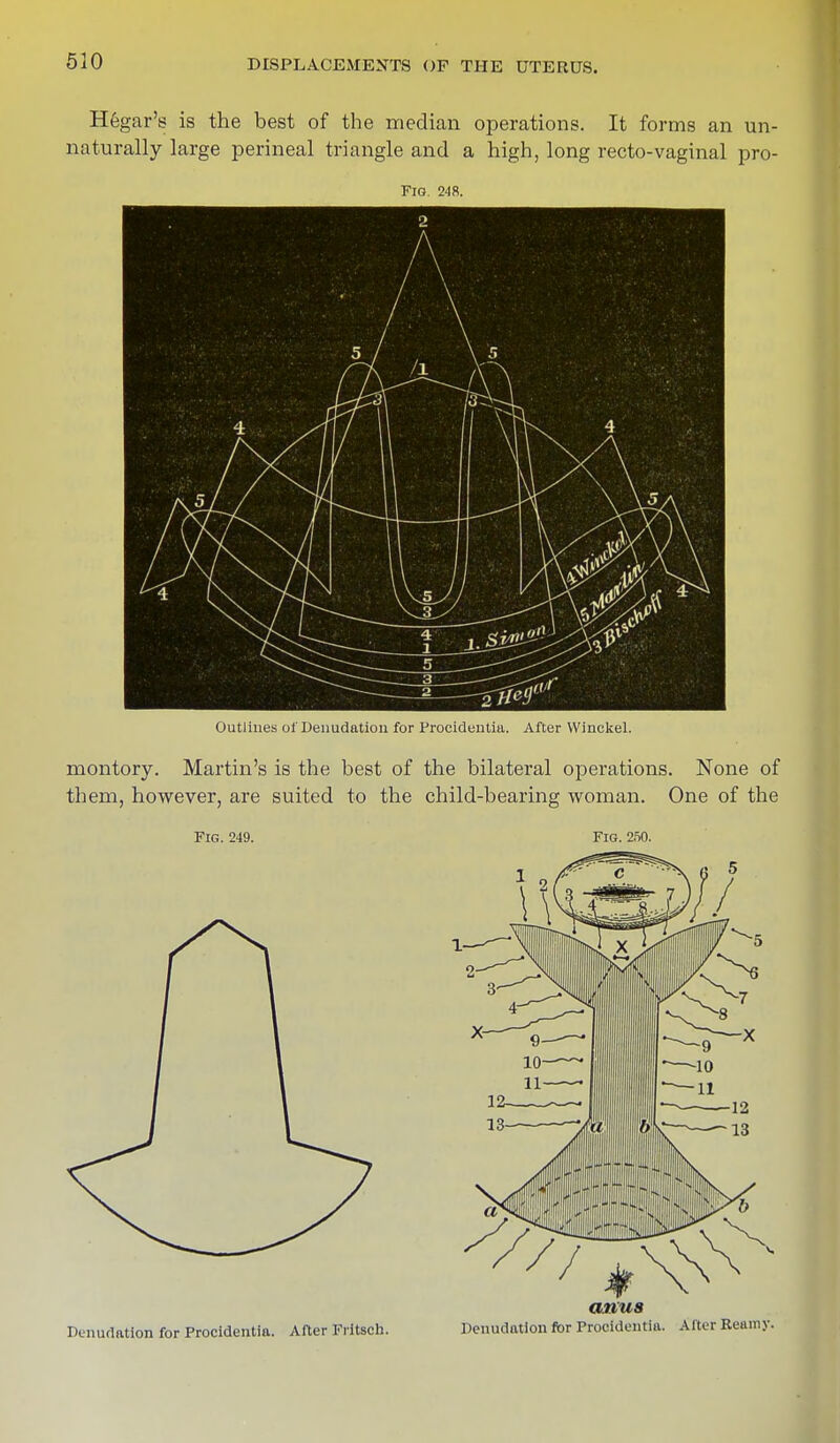 Hegar's is the best of the median operations. It forms an un- naturally large perineal triangle and a high, long recto-vaginal pro- FlG. 248. Outlines of Denudation for Procidentia. After Winckel. montory. Martin's is the best of the bilateral operations. None of them, however, are suited to the child-bearing woman. One of the Fig. 249. Fig. 250. Denudation for Procidentia. After Fritsch. anus Denudation for Procidentia. Alter Reamy.