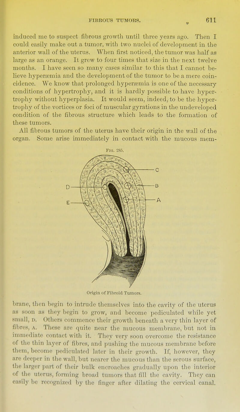 kii;i;oi's tumors. induced me to suspect fibrous growth until three years ago. Then I could easily make out a tumor, with two nuclei of development in the anterior wall of the uterus. When first noticed, the tumor was half as large as an orange. It grew to four times that size in the next twelve months. I have seen so many cases similar to this that I cannot be- lieve hyperemia and the development of the tumor to be a mere coin- cidence. We know that prolonged hyperemia is one of the necessary conditions of hypertrophy, and it is hardly possible to have hyper- trophy without hyperplasia. It would seem, indeed, to be the hyper- trophy of the vortices or foci of muscular gyrations in the undeveloped condition of the fibrous structure which leads to the formation of these tumors. All fibrous tumors of the uterus have their origin in the wall of the organ. Some arise immediately in contact with the mucous mem- FlG. 2S5. A Origin of Fibroid Tumors. brane, then begin to intrude themselves into the cavity of the uterus <>on as they begin to grow, and become pediculated while yet small, D. Others commence their growth beneath a very thin layer of fibres, A. These are quite near the mucous membrane, but not in immediate contact with it. They very soon overcome the resistance of the thin layer of fibres, and pushing the mucous membrane before them,become pediculated later in their growth. If, however, they are deeper in the wall, but nearer the mucous than the serous surface, the larger part of their bulk encroaches gradually upon the interior of the uterus, forming broad tumors that fill the cavity. They can easily he recognized by the finger after dilating the cervical canal.