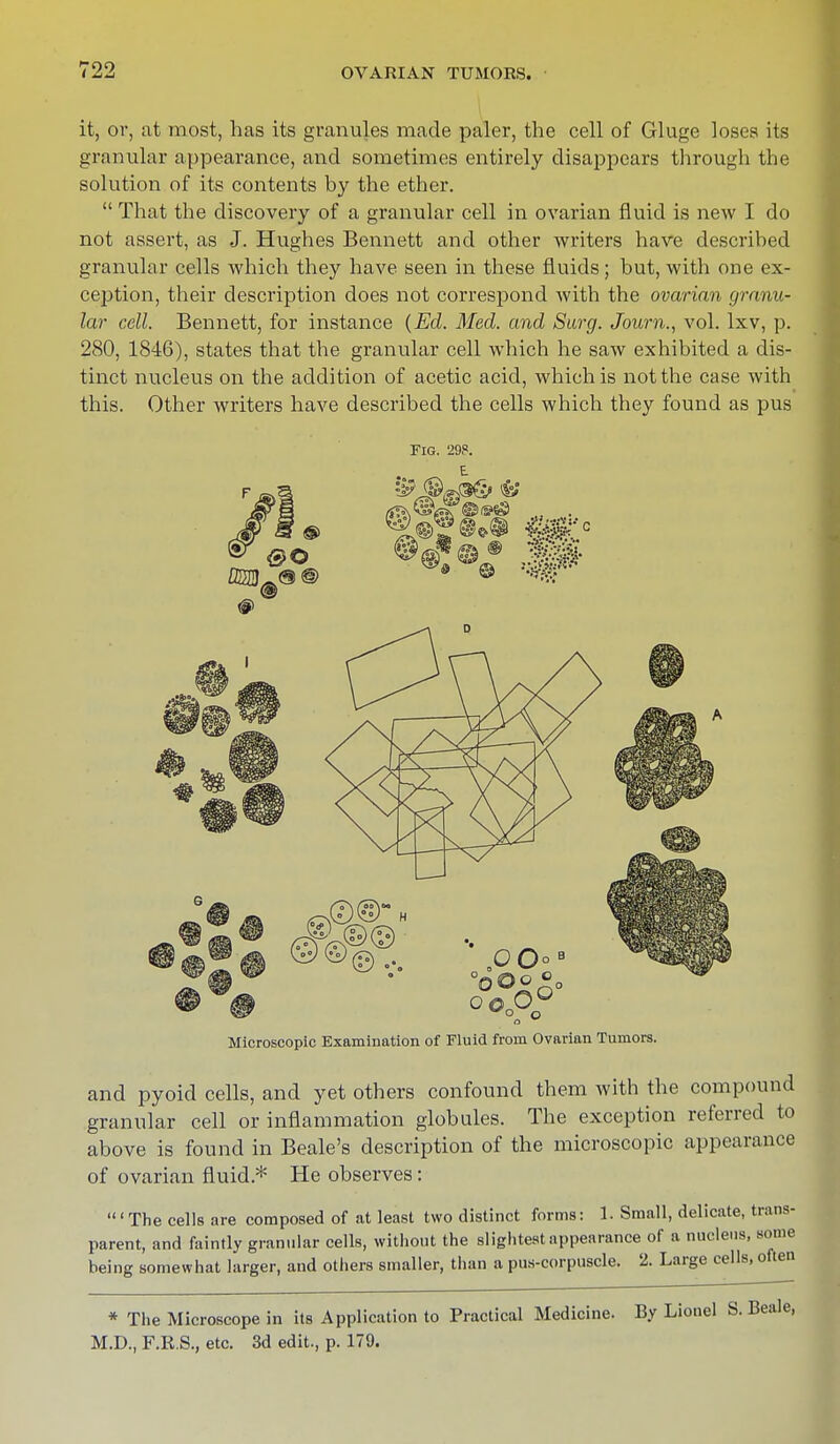 it, ov, at most, has its granules made paler, the cell of Gluge loses its granular appearance, and sometimes entirely disappears through the solution of its contents by the ether.  That the discovery of a granular cell in ovarian fluid is new I do not assert, as J. Hughes Bennett and other writers have described granular cells which they have seen in these fluids; but, with one ex- ception, their description does not correspond with the ovarian granu- lar cell. Bennett, for instance (Ed. Med. and Surg. Journ., vol. lxv, p. 280, 1846), states that the granular cell which he saw exhibited a dis- tinct nucleus on the addition of acetic acid, which is not the case with this. Other writers have described the cells which they found as pus Microscopic Examination of Fluid from Ovarian Tumors. and pyoid cells, and yet others confound them with the compound granular cell or inflammation globules. The exception referred to above is found in Beale's description of the microscopic appearance of ovarian fluid* He observes: 1 The cells are composed of at least two distinct forms: 1. Small, delicate, trans- parent, and faintly granular cells, without the slightest appearance of a nucleus, some being somewhat larger, and others smaller, than a pus-corpuscle. 2. Large cells, often * The Microscope in its Application to Practical Medicine. By Lionel S. Beale, M.D., F.R.S., etc. 3d edit., p. 179.