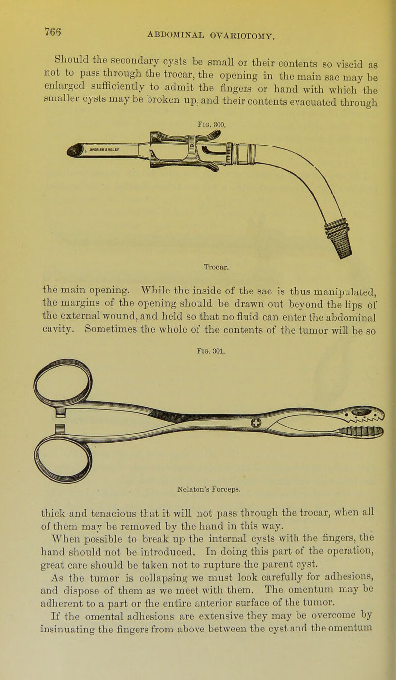 Should the secondary cysts be small or their contents so viscid as not to pass through the trocar, the opening in the main sac may be enlarged sufficiently to admit the fingers or hand with which the smaller cysts may be broken up, and their contents evacuated through Fig. 300. Trocar. the main opening. While the inside of the sac is thus manipulated, the margins of the opening should be drawn out beyond the lips of the external wound, and held so that no fluid can enter the abdominal cavity. Sometimes the whole of the contents of the tumor will be so thick and tenacious that it will not pass through the trocar, when all of them may be removed by the hand in this way. When possible to break up the internal cysts with the fingers, the hand should not be introduced. In doing this part of the operation, great care should be taken not to rupture the parent cyst. As the tumor is collapsing we must look carefully for adhesions, and dispose of them as we meet with them. The omentum may be adherent to a part or the entire anterior surface of the tumor. If the omental adhesions are extensive they may be overcome by insinuating the fingers from above between the cyst and the omentum