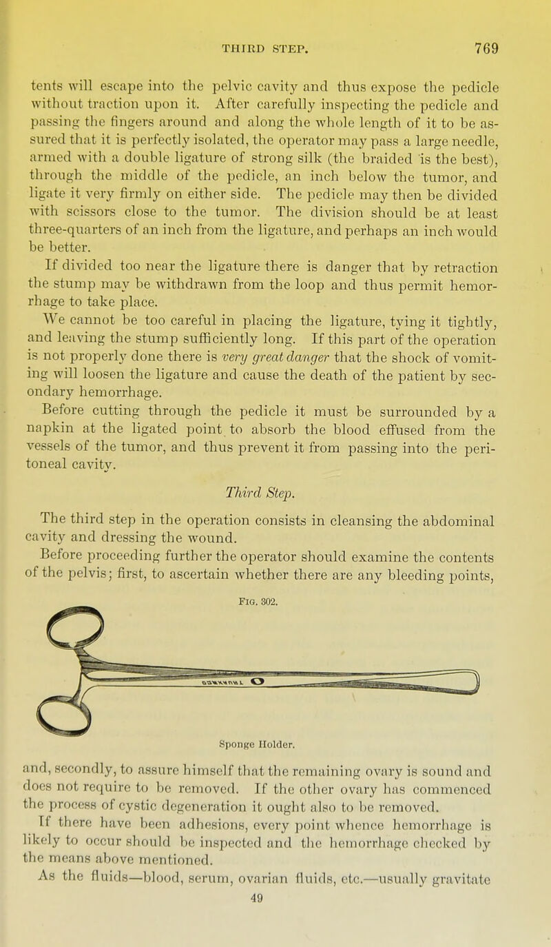 tents will escape into the pelvic cavity and thus expose the pedicle without traction upon it. After carefully inspecting the pedicle and passing the fingers around and along the whole length of it to be as- sured that it is perfectly isolated, the operator may pass a large needle, aimed with a double ligature of strong silk (the braided is the best), through the middle of the pedicle, an inch below the tumor, and ligate it very firmly on either side. The pedicle may then be divided with scissors close to the tumor. The division should be at least three-quarters of an inch from the ligature, and perhaps an inch would be better. If divided too near the ligature there is danger that by retraction the stump may be withdrawn from the loop and thus permit hemor- rhage to take place. We cannot be too careful in placing the ligature, tying it tightly, and leaving the stump sufficiently long. If this part of the operation is not properly done there is very great danger that the shock of vomit- ing will loosen the ligature and cause the death of the patient by sec- ondary hemorrhage. Before cutting through the pedicle it must be surrounded by a napkin at the ligatecl point to absorb the blood effused from the vessels of the tumor, and thus prevent it from passing into the peri- toneal cavity. Third Step. The third step in the operation consists in cleansing the abdominal cavity and dressing the wound. Before proceeding further the operator should examine the contents of the pelvis; first, to ascertain whether there are any bleeding points, Fig. 302. Sponge Holder. and, secondly, to assure himself that the remaining ovary is sound and does not require to be removed. If the other ovary has commenced tin process of cystic degeneration it ought also to be removed. If there have been adhesions, every point whence hemorrhage is likely to occur should be inspected and the hemorrhage checked by the means above mentioned. As the fluids—blood, serum, ovarian fluids, etc.—usually gravitate 49