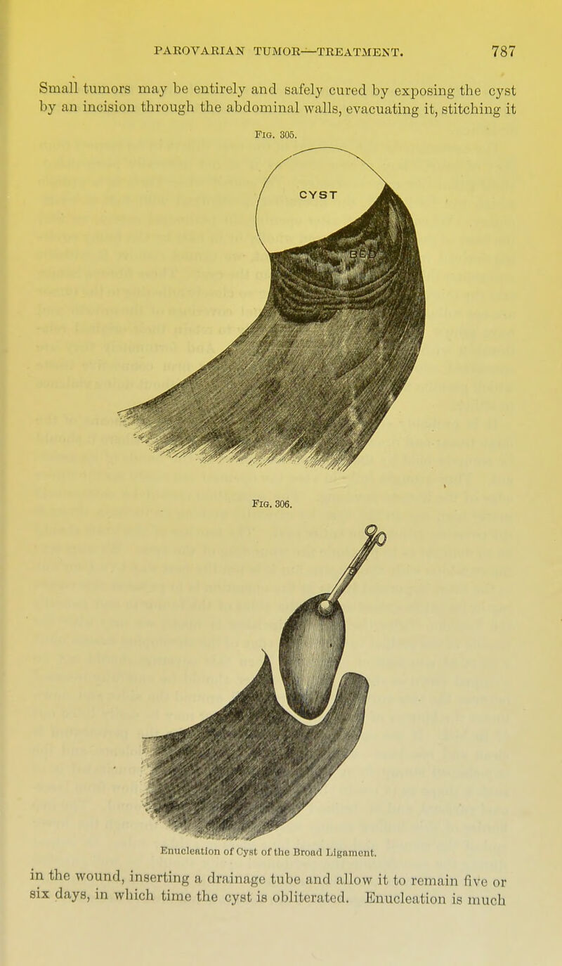 Small tumors may be entirely and safely cured by exposing the cyst by an incision through the abdominal walls, evacuating it, stitching it Fig. 305. in the wound, inserting a drainage tube and allow it to remain five or six days, in which time the cyst is obliterated. Enucleation is much