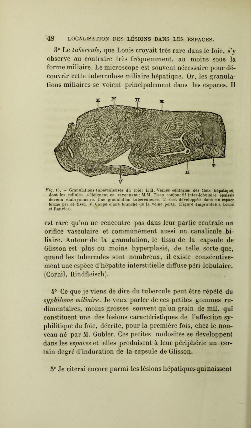 3° Le tubercule, que Louis croyait très rare dans le foie, s’y observe au contraire très fréquemment, au moins sous la forme miliaire. Le microscope est souvent nécessaire pour dé- couvrir cette tuberculose miliaire hépatique. Or, les granula- tions miliaires se voient principalement dans les espaces. Il dont les cellules s'éloignent en rayonnant; M,M, Tissu conjonctif inter-lobulaire épaissie devenu embiyonnaiie. Une granulation tuberculeuse, T, s’est développée dans un espace formé p3r ce tissu. Y, Coupe d’une branche de la veine porte. (Figure empruntée à Cornil et Ranvier). est rare qu’on ne rencontre pas dans leur partie centrale un orifice vasculaire et communément aussi un canalicule bi- liaire. Autour de la granulation, le tissu de la capsule de Glisson est plus ou moins hyperplasié, de telle sorte que, quand les tubercules sont nombreux, il existe consécutive- ment une espèce d’hépatite interstitielle diffuse péri-lobulaire. (Cornil, Rindfleisch). 4° Ce que je viens de dire du tubercule peut être répété du syphilome miliaire. Je veux parler de ces petites gommes ru- dimentaires, moins grosses souvent qu’un grain de mil, qui constituent une des lésions caractéristiques de l’affection sy- philitique du foie, décrite, pour la première fois, chez le nou- veau-né par M. Gubler. Ces petites nodosités se développent dans les espaces et elles produisent à leur périphérie un cer- tain degré d’induration de la capsule de Glisson. 5° Je citerai encore parmi les lésions hépatiques qui naissent