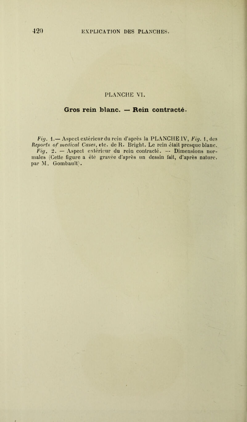 PLANCHE VI. Gros rein blanc. — Rein contracté. Fig. 1.— Aspect extérieur du rein d’après la PLANCHE IV, Fig. l,des Reports of medical Cases, tte. de R. Bright. Le rein était presque blanc. Fig. 2. — Aspect extérieur du rein contracté. — Dimensions nor- males (Cette figure a été gravée d’après un dessin lait, d’après nature, par M. Gombault).