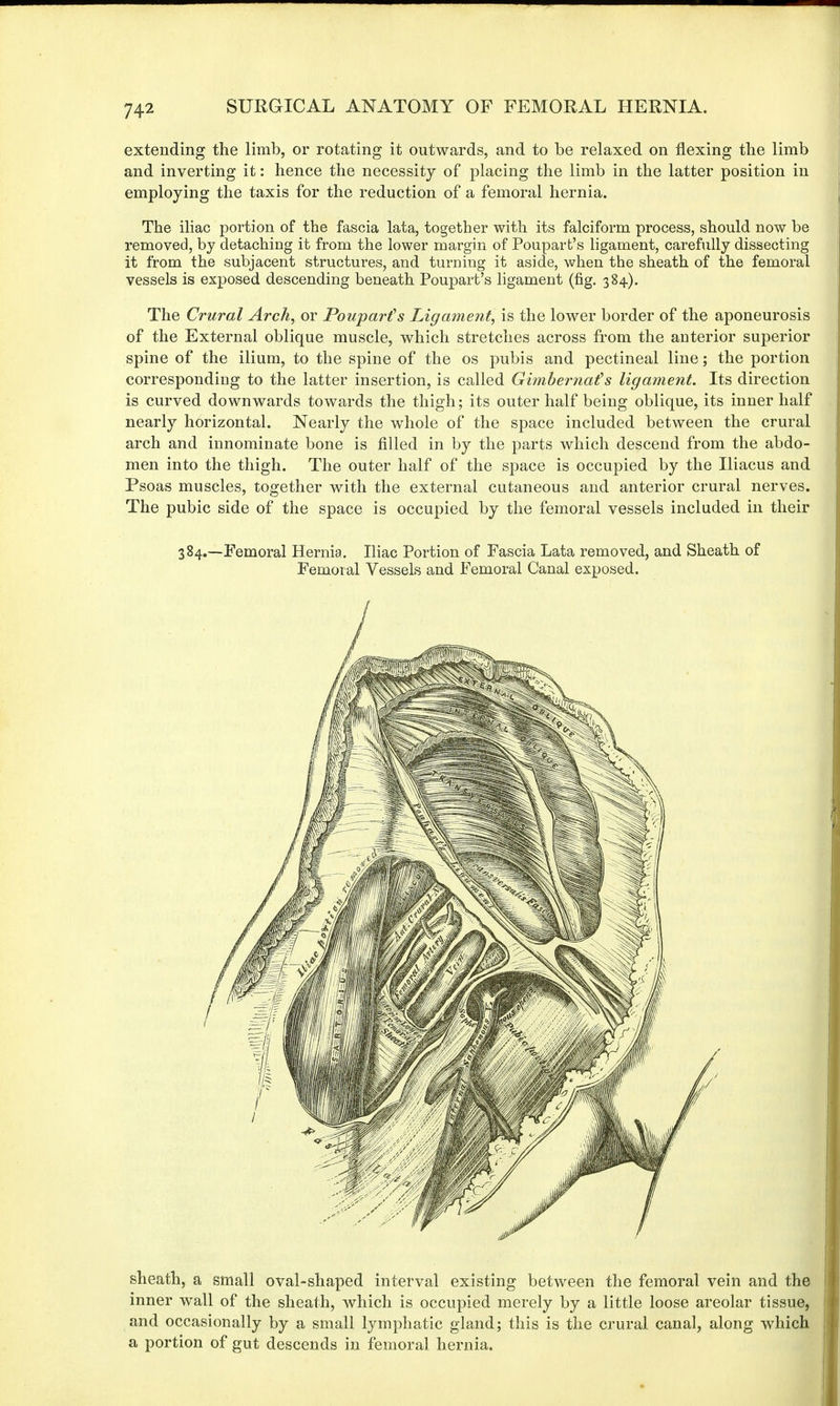 extending the limb, or rotating it outwards, and to be relaxed on flexing the limb and inverting it: hence the necessity of placing the limb in the latter position in employing the taxis for the reduction of a femoral hernia. The iliac portion of the fascia lata, together with its falciform process, should now be removed, by detaching it from the lower margin of Poupart's ligament, carefully dissecting it from the subjacent structures, and turning it aside, when the sheath of the femoral vessels is exposed descending beneath Poupart's ligament (fig. 384). The Crural Arch, or Pouparfs Ligament, is the lower border of the aponeurosis of the External oblique muscle, which stretches across from the anterior superior spine of the ilium, to the spine of the os pubis and pectineal line; the portion corresponding to the latter insertion, is called Gimbernafs ligament. Its direction is curved downwards towards the thigh; its outer half being oblique, its inner half nearly horizontal. Nearly the whole of the space included between the crural arch and innominate bone is filled in by the parts which descend from the abdo- men into the thigh. The outer half of the space is occupied by the Iliacus and Psoas muscles, together with the external cutaneous and anterior crural nerves. The pubic side of the space is occupied by the femoral vessels included in their 384.—Femoral Hernia. Iliac Portion of Fascia Lata removed, and Sheath of Femoral Vessels and Femoral Canal exposed. sheath, a small oval-shaped interval existing between the femoral vein and the inner wall of the sheath, which is occupied merely by a little loose areolar tissue, and occasionally by a small lymphatic gland; this is the crural canal, along which a portion of gut descends in femoral hernia.