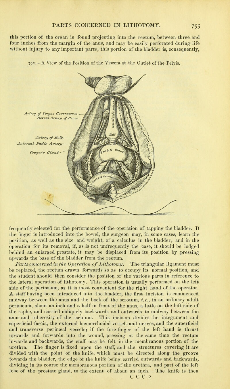 PARTS CONCERNED IN LITHOTOMY. this portion of the organ is found projecting into the rectum, between three and four inches from the margin of the anus, and may be easily perforated during life without injury to any important parts; this portion of the bladder is, consequently, 392.—A View of the Position of the Viscera at the Outlet of the Pelvis. frequently selected for the performance of the operation of tapping the bladder. If the finger is introduced into the bowel, the surgeon may, in some cases, learn the position, as well as the size and weight, of a calculus in the bladder; and in the operation for its removal, if, as is not unfrequently the case, it should be lodged behind an enlarged prostate, it may be displaced from its position by pressing upwards the base of the bladder from the rectum. Parts concerned in the Operation of Lithotomy. The triangular ligament must be replaced, the rectum drawn forwards so as to occupy its normal position, and the student should then consider the position of the various parts in reference to the lateral operation of lithotomy. This operation is usually performed on the left side of the peringeum, as it is most convenient for the right hand of the operator. A staff having been introduced into the bladder, the first incision is commenced midway between the anus and the back of the scrotum, i.e., in an ordinary adult perinseum, about an inch and a half in front of the anus, a little on the left side of the raphe, and carried obliquely backwards and outwards to midway between the anus and tuberosity of the ischium. This incision divides the integument and superficial fascia, the external hasmorrhoidal vessels and nerves, and the superficial and transverse perinaeal vessels; if the fore-finger of the left hand is thrust upwards and forwards into the wound, pressing at the same time the rectum inwards and backwards, the staff may be felt in the membranous portion of the urethra. The finger is fixed upon the staff, and the structures covering it are divided with the point of the knife, which must be directed along the groove towards the bladder, the edge of the knife being carried outwards and backwards, dividing in its course the membranous portion of the urethra, and part of the left lobe of the prostate gland, to the extent of about an inch. The knife is then C C C 2