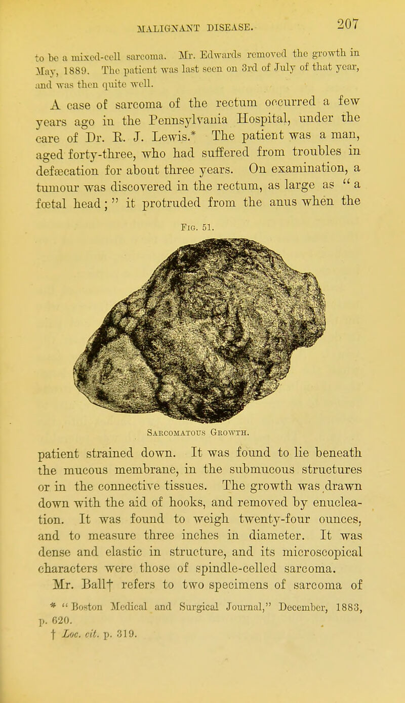 to be a mixcd-coll sarcoma. Mr. Edwards removed the growth in May, 1889. The patient was last seen on 3rd of Jnly of that year, ;ind was then quite well. A case of sarcoma of the rectum occurred a few years ago in tlie Pennsylvauia Hospital, under the care of Dr. K. J. Lewis.* The patient was a man, aged forty-three, who had suffered from troubles in defascation for about three years. On examination, a tumour was discovered in the rectum, as large as  a fcetal head;  it protruded from the anus when the Fig. 51. Sarcomatous Growth. patient strained down. It was found to lie beneath the mucous membrane, in the submucous structures or in the connective tissues. The growth was drawn down with the aid of hooks, and removed by enuclea- tion. It was found to weigh twenty-four ounces, and to measure three inches in diameter. It was dense and elastic in structure, and its microscopical characters were those of spindle-celled sarcoma. Mr. Ballf refers to two specimens of sarcoma of * Boston Medical and Surgical Journal, December, 1883, p. 620. t Loc. cit. p. 319.