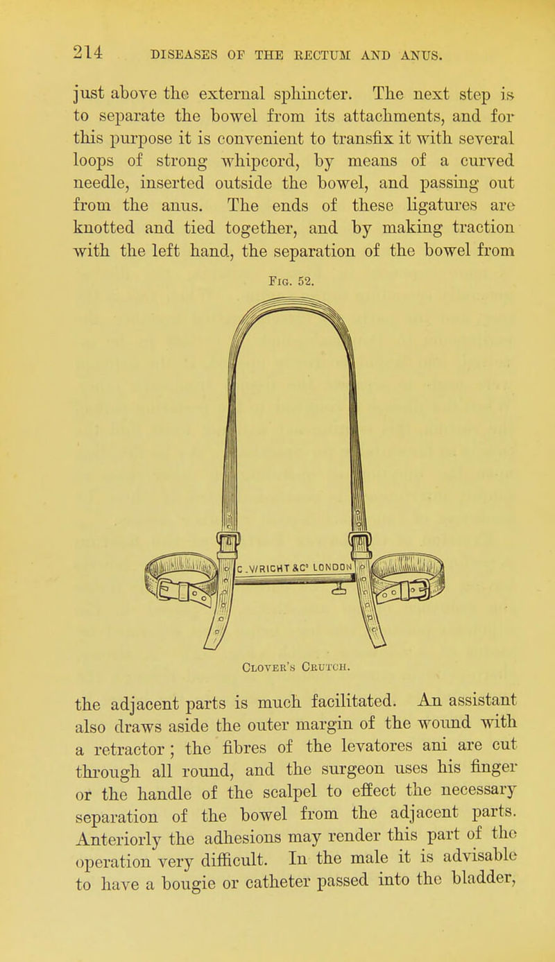 just above the external sphincter. The next step i,s to separate the bowel from its attachments, and for this purpose it is convenient to transfix it with several loops of strong whipcord, by means of a curved needle, inserted outside the bowel, and passing out from the anus. The ends of these ligatures are knotted and tied together, and by making traction with the left hand, the separation of the bowel from Fig. 52. Cloyer's Ckutch. the adjacent parts is much facilitated. An assistant also draws aside the outer margin of the wound with a retractor ; the fibres of the levatores ani are cut through all round, and the surgeon uses his finger or the handle of the scalpel to efPect the necessary separation of the bowel from the adjacent parts. Anteriorly the adhesions may render this part of the operation very difficult. In the male it is advisable to have a bougie or catheter passed into the bladder,