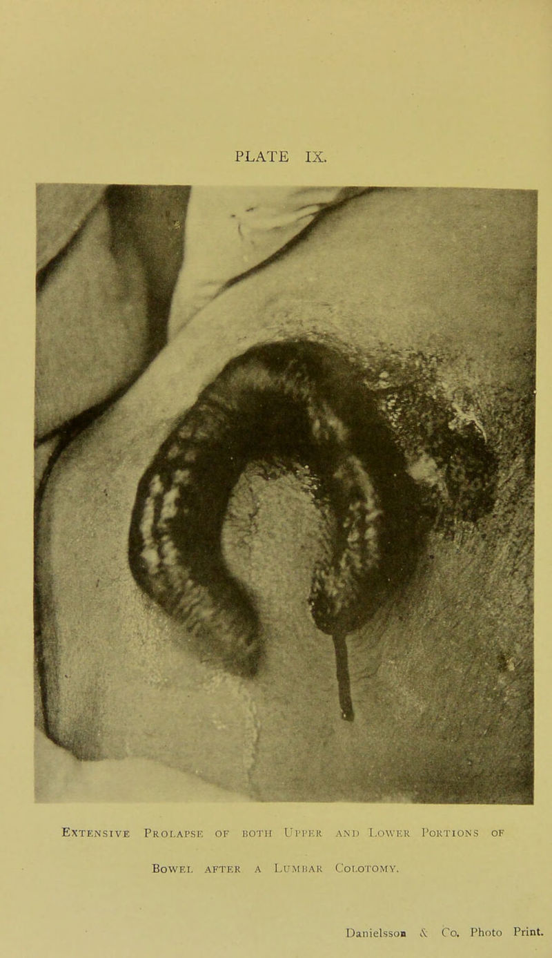 Extensive Prolapse of both I'ri'icR ami T.ower Portions of BoWEI. AFTER A LUMIiAR CoI.OTOMY. DanielssoB I'v: Co. Photo Print.