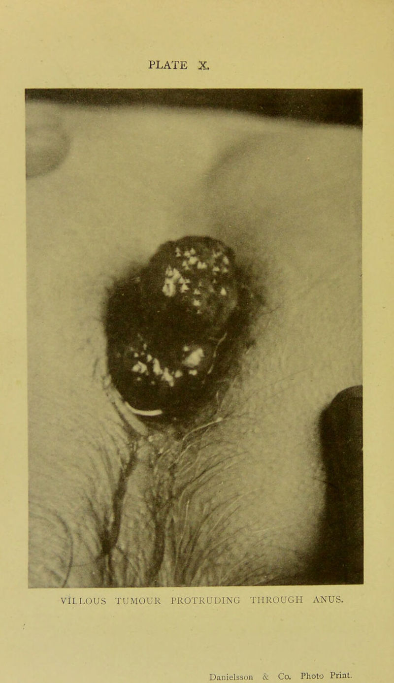 PLATE X. VILLOUS TUMOUR PROTRUDING THROUGH ANUS. Daiiielsson & Co. Photo Print.