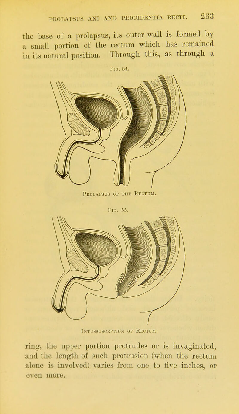 the base of a prolapsus, its outer wall is formed by a small portion of the rectum which has remained in its natural position. Through this, as through u Fio. 54. Prolapsus of the Rectum. Fig. 55. IXTU-SSUSCEPTION OK RECTUM. ring, the upper portion protrudes or is invaginated, and the length of such protrusion (when the rectuui alone is involved) varies from one to five inches, or even more.