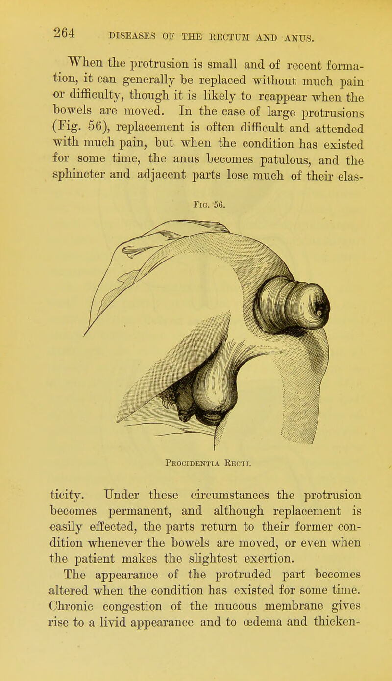 When the protrusion is small and of recent forma- tion, it can generally be replaced without much pain or difficulty, though it is likely to reappear when the bowels are moved. In the case of large protrusions (Fig. 56), replacement is often difficult and attended with much pain, but when the condition has existed for some time, the anus becomes patulous, and the sphincter and adjacent parts lose much of theii- elas- FiG. 56. Procidentia Eecti. ticity. Under these circumstances the protrusion becomes permanent, and although replacement is easily effected, the parts return to their former con- dition whenever the bowels are moved, or even when the patient makes the slightest exertion. The appearance of the protruded part becomes altered when the condition has existed for some time. Chronic congestion of the mucous membrane gives rise to a livid appearance and to oedema and thicken-