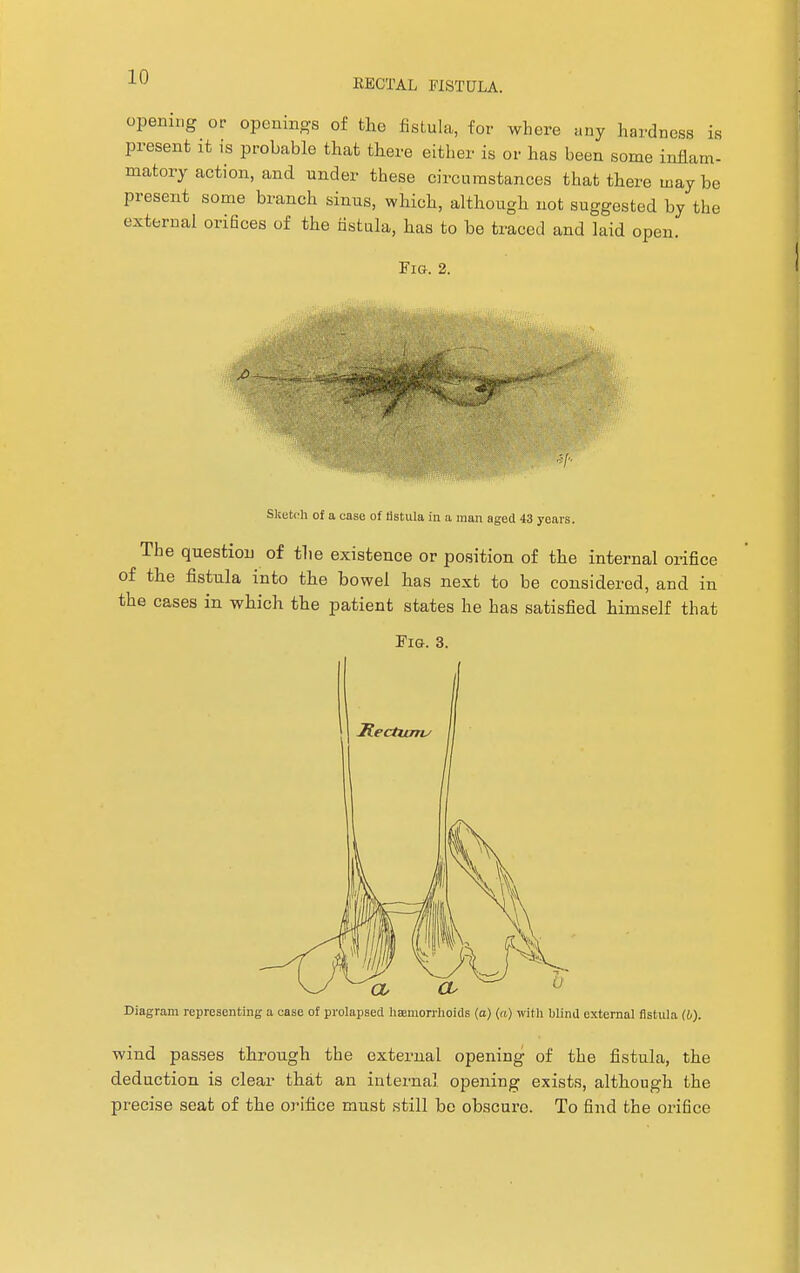 RECTAL FISTULA. opening or openings of the fistula, for where any hardness is present it is probable that there either is or has heen some inflam- matory action, and under these circumstances that there may be present some branch sinus, which, although not suggested by the external orifices of the fistula, has to be traced and laid open. Fig. 2. Sketch of a case of fistula in a man aged 43 years. rhe question of the existence or position of the internal orifice the fistula into the bowel has next to be considered, and in : cases in which the patient states he has satisfied himself that Pig. 3. Diagram representing a case of prolapsed haemorrhoids (a) (a) with blind external fistula (b). wind passes through the external opening of the fistula, the deduction is clear that an internal opening exists, although the precise seat of the orifice must still be obscure. To find the orifice