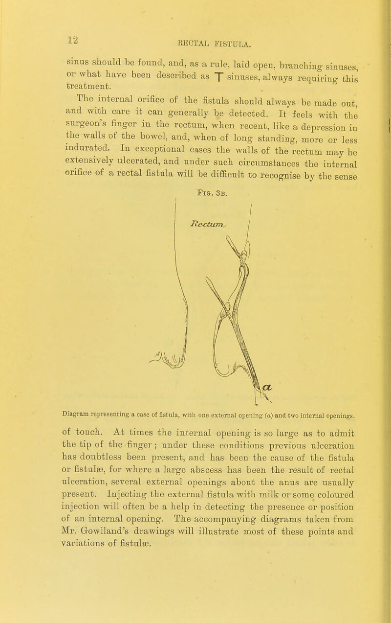 sinus should be found, and, as a rule, laid open, branching sinuses, or what have been described as J sinuses, always requiring this treatment. The internal orifice of the fistula should always be made out, and with care it can generally be detected. It feels with the surgeon's finger in the rectum, when recent, like a depression in the walls of the bowel, and, when of long standing, more or less indurated. In exceptional cases the walls of the rectum may be extensively ulcerated, and under such circumstances the internal orifice of a rectal fistula will be difficult to recognise by the sense Fig. 3b. Ite-ctum. Diagram representing a case of fistula, with one external opening (a) and two internal openings. of touch. At times the internal opening is so large as to admit the tip of the finger; under these conditions previous ulceration has doubtless been present, and has been the cause of the fistula or fistula?, for where a large abscess has been the result of rectal ulceration, several external openings about the anus are usually present. Injecting the external fistula with milk or some coloured injection will often be a help in detecting the presence or position of an internal opening. The accompanying diagrams taken from Mr. Growlland's drawings will illustrate most of these points and variations of fistula?.