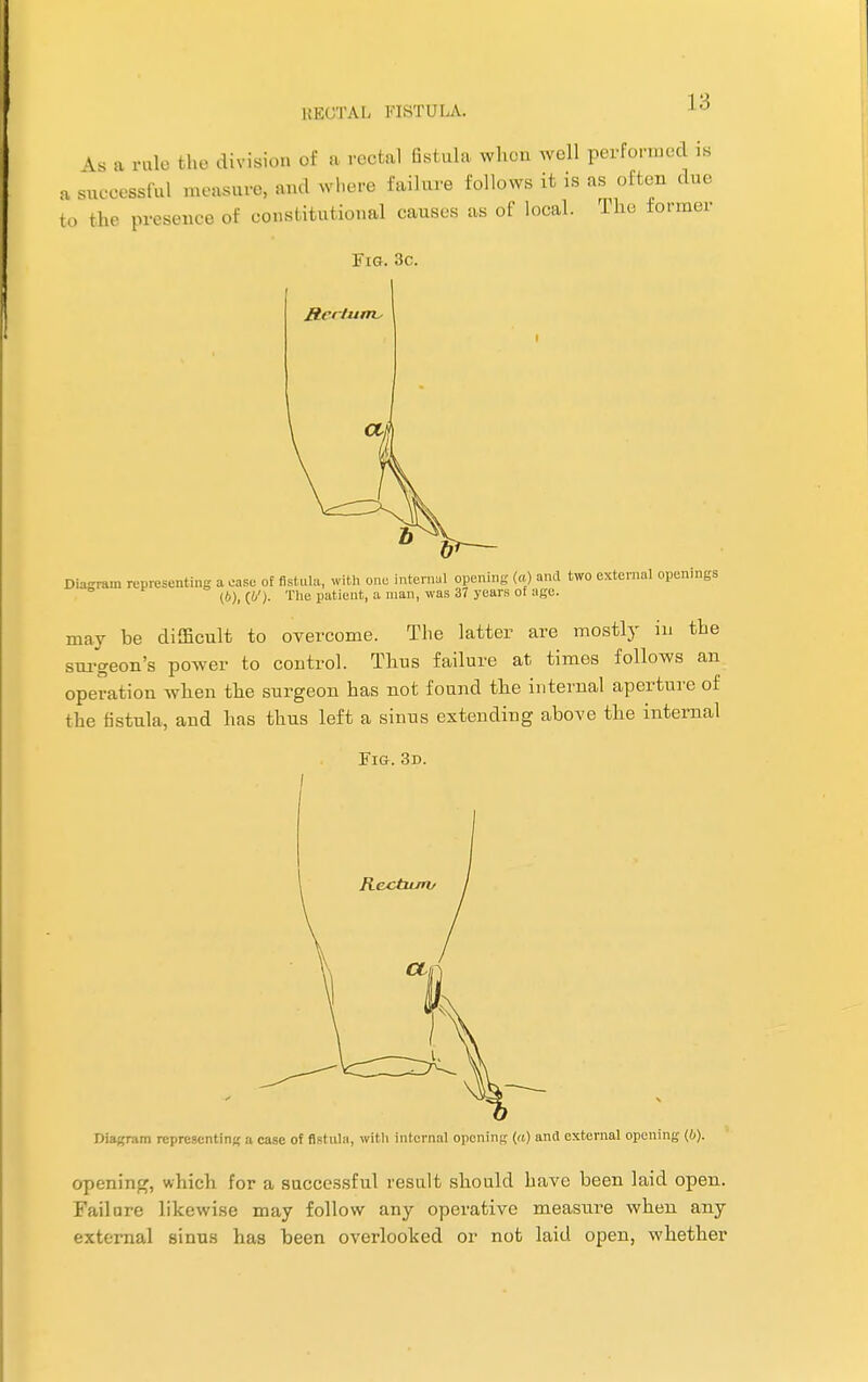 As a rule tin- division of a rectal fistula, when well performed is a successful measure, and where failure follows it is as often due to the presence of constitutional causes as of local. The former Fig. 3c. Diagram representing a ease of fistula, with one internal opening (a) and two external openings (6), (&')■ The patient, a man, was 37 years of age. may be difficult to overcome. The latter are mostly in the surgeon's power to control. Thus failure at times follows an operation when the surgeon has not found the internal aperture of the fistula, and has thus left a sinus extending above the internal Fig. 3d. Diagram representing a case of fistula, with internal opening («) and external opening (6). opening, which for a successful result should have been laid open. Failure likewise may follow any operative measure when any external sinus has been overlooked or not laid open, whether