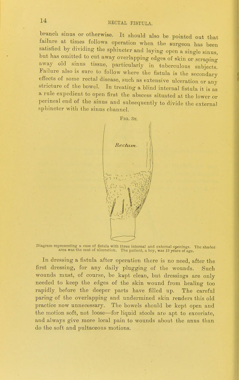 RECTAL FISTULA. branch sinus or otherwise. It should also be pointed out that failure at times follows operation when the surgeon has been satisfied by dividing the sphincter and laying open a single sinus but has omitted to cut away overlapping edges of skin or°scraping away old sinus tissue, particularly in tuberculous subjects Failure also is sure to follow where the fistula is the secondary effects of some rectal disease, such as extensive ulceration or any stricture of the bowel. In treating a blind internal fistula it is as a rule expedient to open first the abscess situated at the lower or perineal end of the sinus and subsequently to divide the external sphincter with the sinus channel. Fig. 3e. Diagram representing a case of astula with three internal and external openings. The shaded area was the seat of ulceration. The patient, a boy, was 19 years of age. In dressing a fistula after operation there is no need, after the first dressing, for any daily plugging of the wounds. Such wounds must, of course, be kept clean, but dressings are only needed to keep the edges of the skin wound from healing too rapidly before the deeper parts have filled up. The careful paring of the overlapping and undermined skin renders this old practice now unnecessary. The bowels should be kept open and the motion soft, not loose—for liquid stools are apt to excoriate, and always give more local pain to wounds about the anus than do the soft and pultaceous motions.