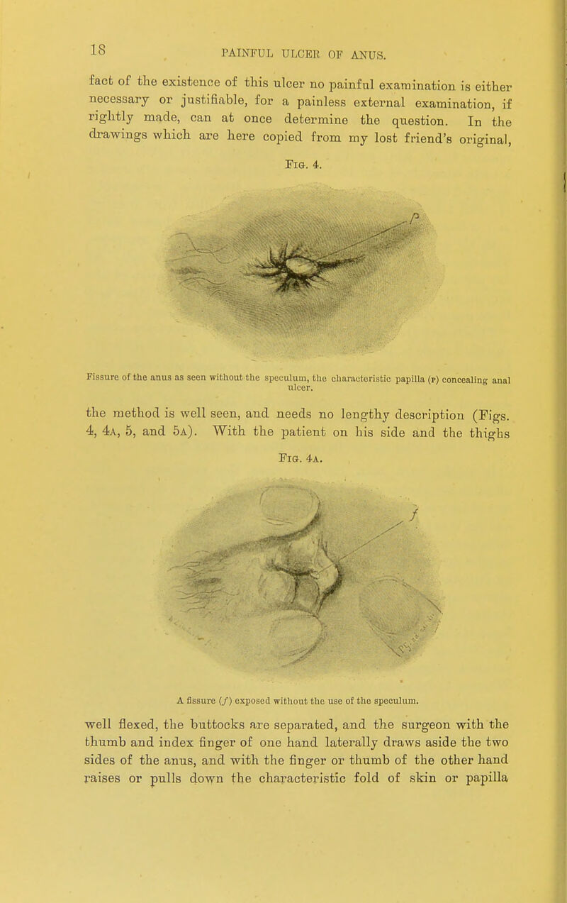 fact of the existence of this ulcer no painful examination is either necessary or justifiable, for a painless external examination, if rightly made, can at once determine the question. In the drawings which are here copied from my lost friend's original, Fig. 4. Fissure of the anus as seen without the speculum, the characteristic papilla (p) concealing anal ulcer. the method is well seen, and needs no lengthy description (Figs. 4, 4a, 5, and 5a). With the patient on his side and the thighs Pro. 4a. A fissure (/) exposed without the use of the speculum. well flexed, the buttocks are separated, and the surgeon with the thumb and index finger of one hand laterally draws aside the two sides of the anus, and with the finger or thumb of the other hand raises or pulls down the characteristic fold of skin or papilla