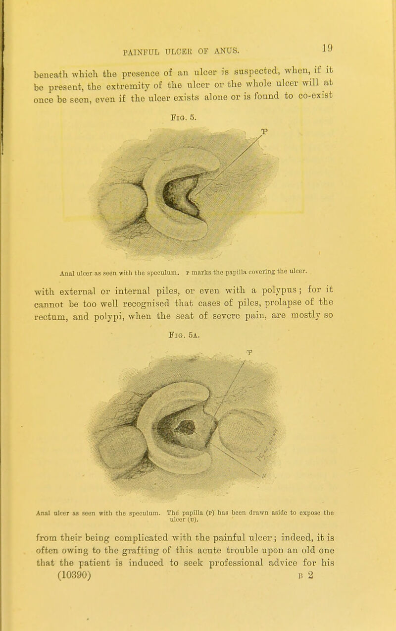 10 beneath which the presence of an ulcer is suspected, when, if it be present, the extremity of the ulcer or the whole ulcer will at once be seen, even if the ulcer exists alone or is found to co-exist Fig. 5. Anal ulcer as seen with the speculum, p marks the papilla, covering the ulcer. with external or internal piles, or even with a polypus ; for it cannot be too well recognised that cases of piles, prolapse of the rectum, and polypi, when the seat of severe pain, are mostly so Fig. 5a. T Anal nicer as seen with the speculum. The papilla (p) has heen drawn aside to expose the ulcer (u). from their being complicated with the painful ulcer; indeed, it is often owing to the grafting of this acute trouble upon an old one that the patient is induced to seek professional advice for his (10390) u 2