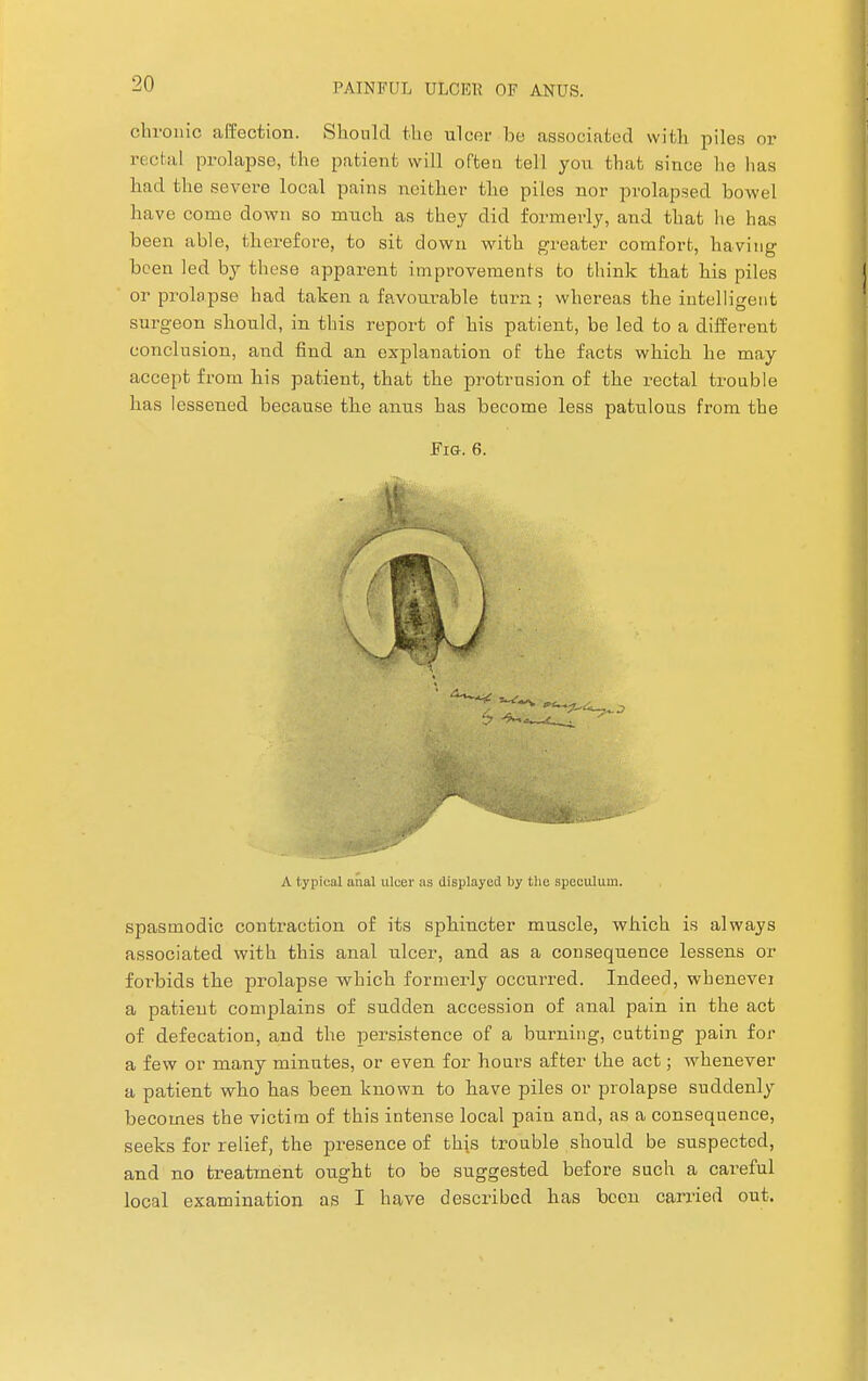 chronic affection. Should the ulcer be associated with piles or rectal prolapse, the patient will often tell you that since he lias had the sevei-e local pains neither the piles nor prolapsed boAvel have come down so much as they did formerly, and that lie has been able, therefore, to sit down with greater comfort, having been led by these apparent improvements to think that his piles or prolapse had taken a favourable turn ; whereas the intelligent surgeon should, in this report of his patient, be led to a different conclusion, and find an explanation of the facts which he may accept from his patient, that the protrusion of the rectal trouble has lessened because the anus has become less patulous from the Fi&. 6. A typical anal ulcer as displayed by the speculum. spasmodic contraction of its sphincter muscle, which is always associated with this anal ulcer, and as a consequence lessens or forbids the prolapse which formerly occurred. Indeed, whenevei a patient complains of sudden accession of anal pain in the act of defecation, and the persistence of a burning, cutting pain for a few or many minutes, or even for hoars after the act; whenever a patient who has been known to have piles or prolapse suddenly becomes the victim of this intense local pain and, as a consequence, seeks for relief, the presence of this trouble should be suspected, and no treatment ought to be suggested before such a careful local examination as I have described has been carried out.