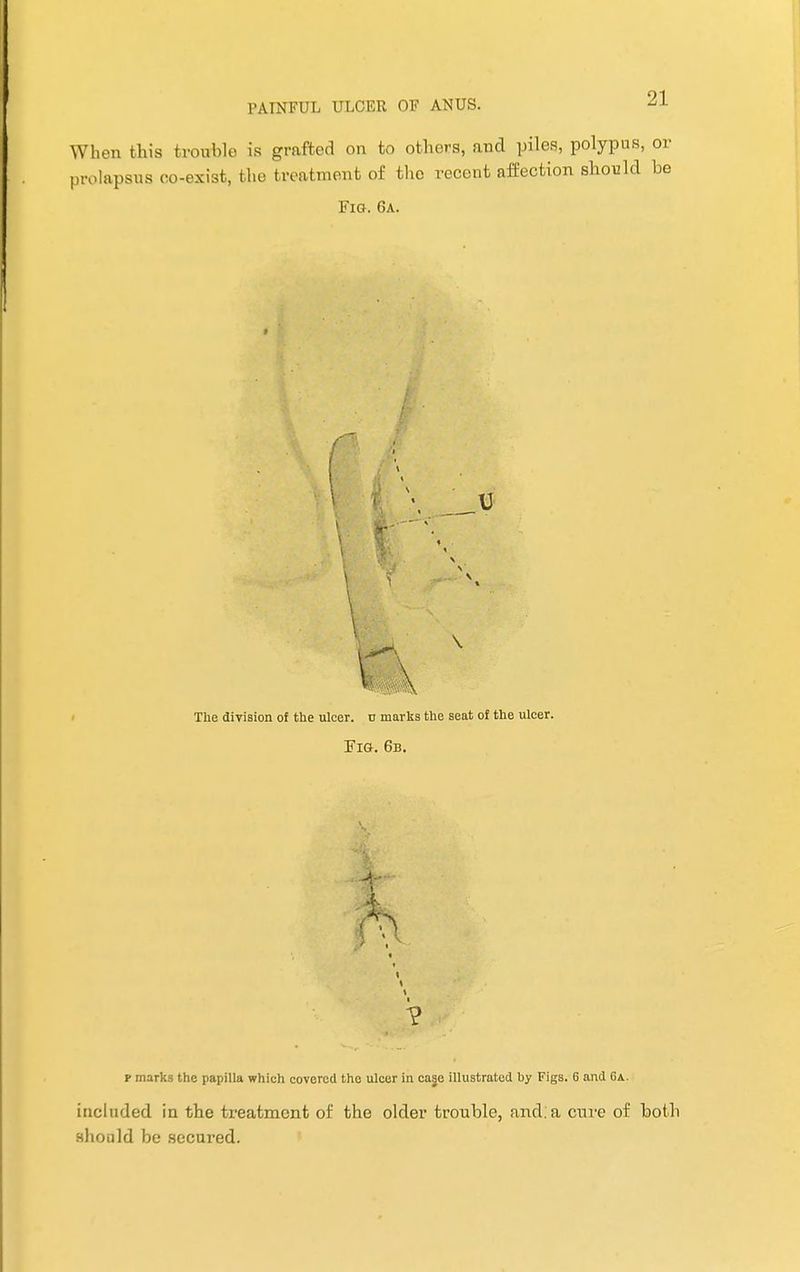 When this trouble is grafted on to others, find piles, polypus, or prolapsus co-exist, the treatment of the recent affection should be Fig. 6a. The division of the ulcer, tr marks the seat of the ulcer. Fig. 6b. ? p marks the papilla which covered the ulcer in caje illustrated by Figs. 6 and 6a. included in the treatment of the older trouble, and:a cure of both should be .secui'ed.