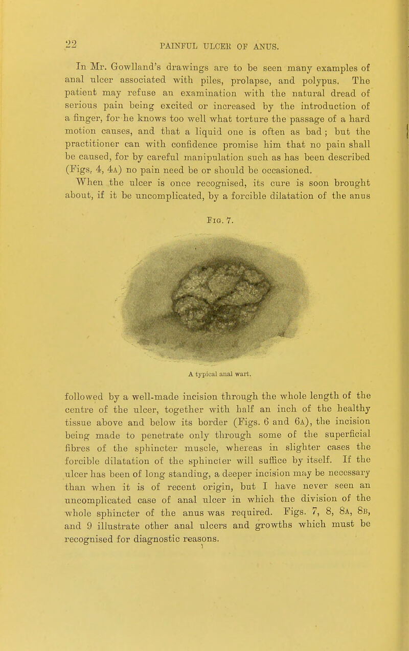 In Mr. Gowlland's drawings are to be seen many examples of anal nicer associated with piles, prolapse, and polypus. The patient may refuse an examination with the natural dread of serious pain being excited or increased by the introduction of a finger, for he knows too well what torture the passage of a hard motion causes, and that a liquid one is often as bad ; but the practitioner can with confidence promise him that no paiti shall be caused, for by careful manipulation such as has been described (Figs, 4, 4a) no pain need be or should be occasioned. When the ulcer is once recognised, its cure is soon brought about, if it be uncomplicated, by a forcible dilatation of the anus Fig. 7. A typical anal wart. followed by a well-made incision through the whole length of the centre of the ulcer, together with half an inch of the healthy tissue above and below its border (Figs. 6 and 6a), the incision being made to penetrate only through some of the superficial fibres of the sphincter muscle, whereas in slighter cases the forcible dilatation of the sphincter will suffice by itself. If the ulcer has been of long standing, a deeper incision may be necessary than when it is of recent origin, but I have never seen an uncomplicated case of anal ulcer in which the division of the whole sphincter of the anus was required. Figs. 7, 8, 8a, 8b, and 9 illustrate other anal ulcers and growths which must be recognised for diagnostic reasons.