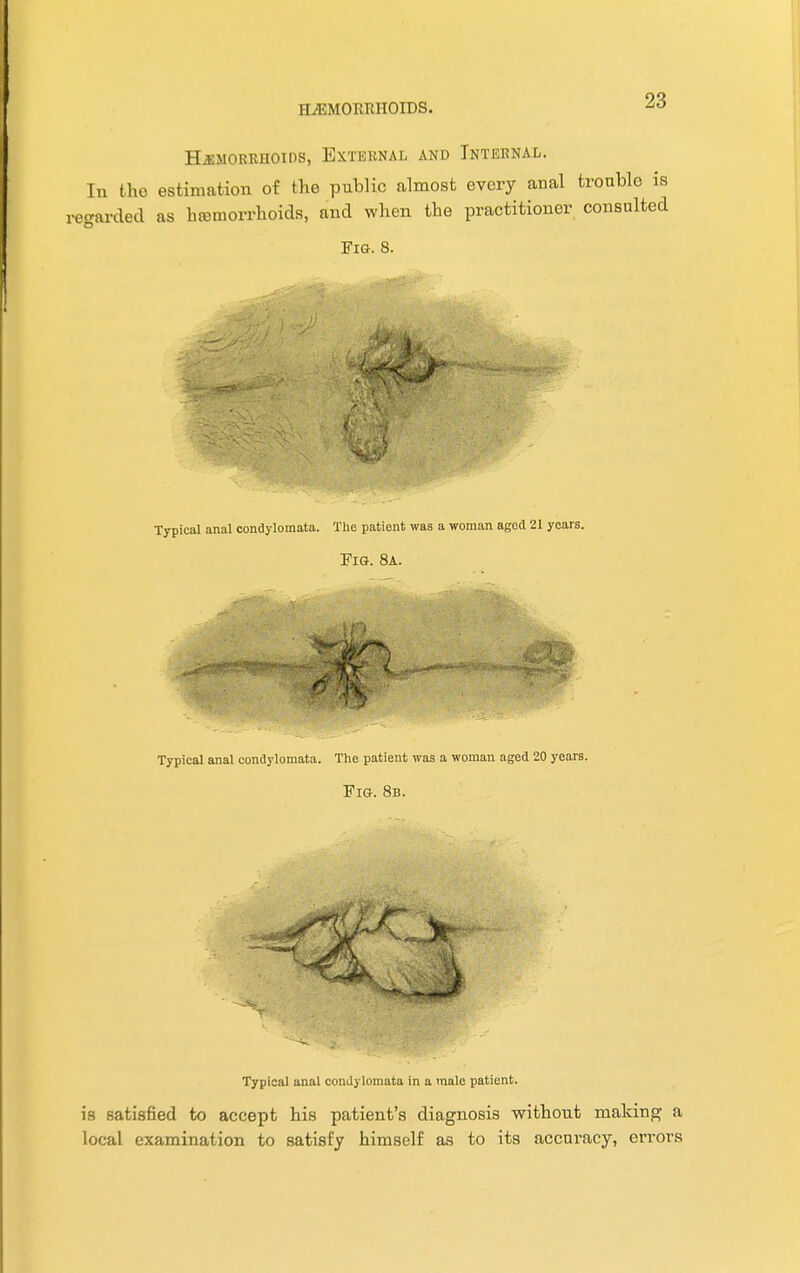 HEMORRHOIDS. 2^ Hemorrhoids, External and Internal. In tho estimation of the public almost every anal trouble is regarded as htemorrhoids, and when the practitioner consulted Fig. 8. Typical anal condylomata in a male patient. is satisfied to accept his patient's diagnosis without making a local examination to satisfy himself as to its accuracy, errors