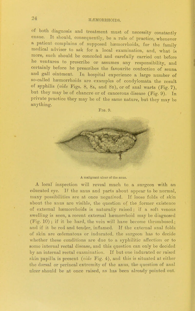 HAEMORRHOIDS. of both diagnosis and treatment must of necessity constantly ensue. It should, consequently, be a rule of practice, whenever a patient complains of supposed haemorrhoids, for the family medical adviser to ask for a local examination, and, what is more, such should be conceded and carefully carried out before he ventures to prescribe or assumes any responsibility, and certainly before he prescribes the favourite confection of senna and gall ointment. In hospital experience a large number of so-called haemorrhoids are examples of condylomata the result of syphilis (vide Figs. 8, 8a, and 8b), or of anal warts (Fig. 7), but they may be of chancre or of cancerous disease (Fig. 9). In private practice they may be of the same nature, but they may be anything. Tig. 9. A malignant ulcer of the anus. A local inspection will reveal much to a surgeon with an educated eye. If the anus and parts about appear to be normal, many possibilities are at once negatived. If loose folds of skin about the anus are visible, the question of the former existence of external haemorrhoids is naturally raised ; if a soft, venous swelling is seen, a recent external haemorrhoid may be diagnosed (Fig. 10) ; if it be hard, the vein will have become thrombosed ; and if it be red and tender, inflamed. If the external anal folds of skin are oerlematous or indurated, the surgeon has to decide whether these conditions are due to a syphilitic affection or to some internal rectal disease, and this question can only be decided by an internal rectal examination. If but one indurated or raised ■skin papilla is present (vide Fig. 4). and this is situated at either the dorsal or perineal extremity of the anus, the question of anal ulcer should be at once raised, ns has been already pointed out.