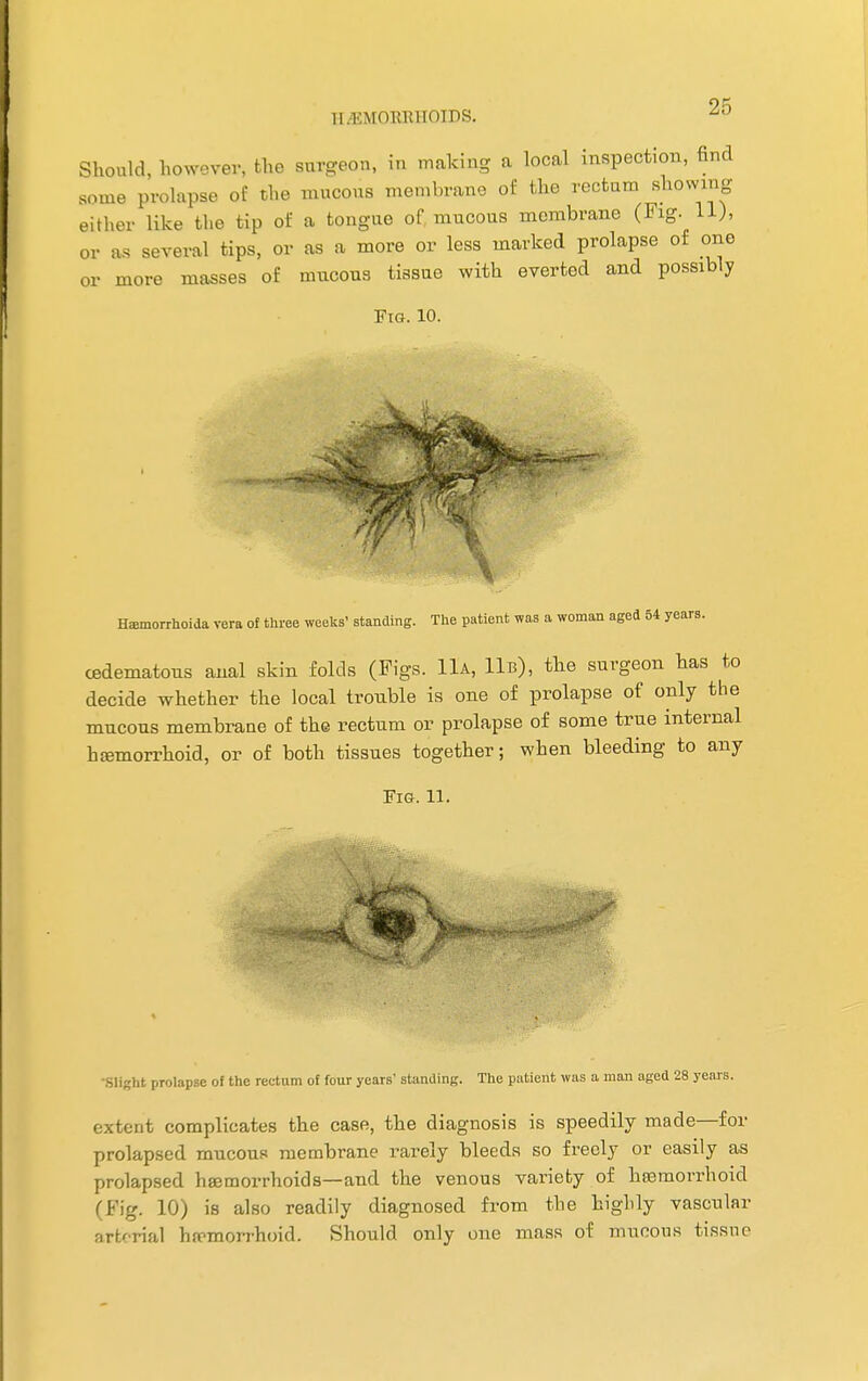 ii i \i<)i;i;iiomS. Should, however, the surgeon, in making a local inspection, find some prolapse of the mucous membrane of the rectum showing either like the tip of a tongue of mucous membrane (Fig. 11), or as several tips, or as a more or less marked prolapse of one or more masses of mucous tissue with everted and possibly Fig. 10. Hsmorrhoida vera of three weeks' standing. The patient was a woman aged 54 years. cedematous anal skin folds (Pigs. 11a, 11b), the surgeon has to decide whether the local trouble is one of prolapse of only the mucous membrane of the rectum or prolapse of some true internal hemorrhoid, or of both tissues together; when bleeding to any Fig. 11. •Slight prolapse of the rectum of four years' standing. The patient was a man aged 28 years. extent complicates the case, the diagnosis is speedily made—for prolapsed mucous membrane rarely bleeds so freely or easily as prolapsed hemorrhoids—and the venous variety of hemorrhoid (Fig. 10) is also readily diagnosed from the highly vascular arterial hemorrhoid. Should only one mass of mucous tissue