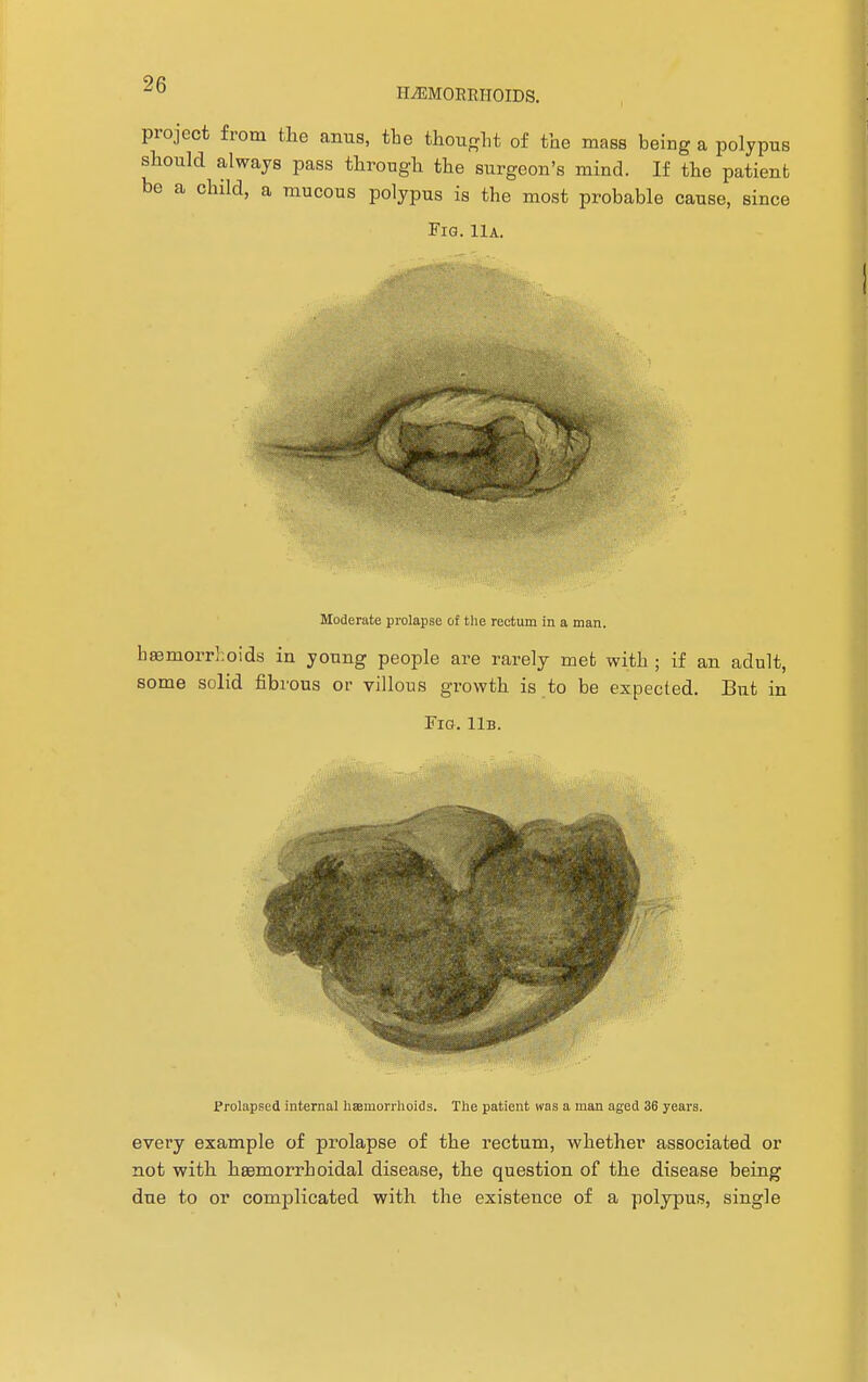HEMORRHOIDS. project from the anus, the thought of the mass being a polypus should always pass through the surgeon's mind. If the patient be a child, a mucous polypus is the most probable cause, since Fig. Ha. Moderate prolapse of the rectum in a man. baamorrhoids in young people are rarely met with ; if an adult, some solid fibrous or villous growth is to be expected. But in Fig. 11b. Prolapsed internal haemorrhoids. The patient was a man aged 36 years. every example of prolapse of the rectum, whether associated or not with hsemorrhoidal disease, the question of the disease being due to or complicated with the existence of a polypus, single